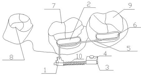 A device for advancing mandibular molars