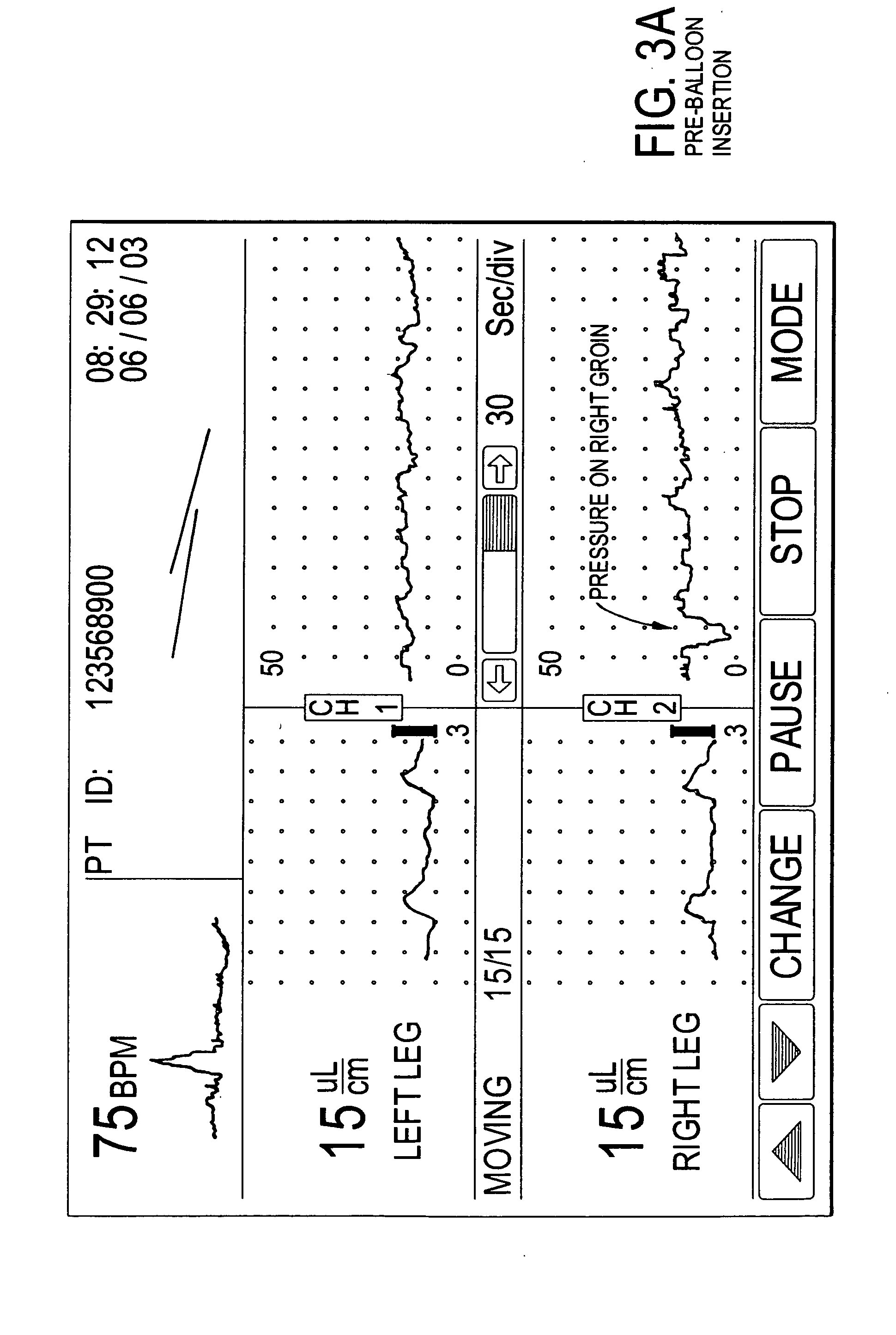 Methods of diagnosis using pulse volume measurement