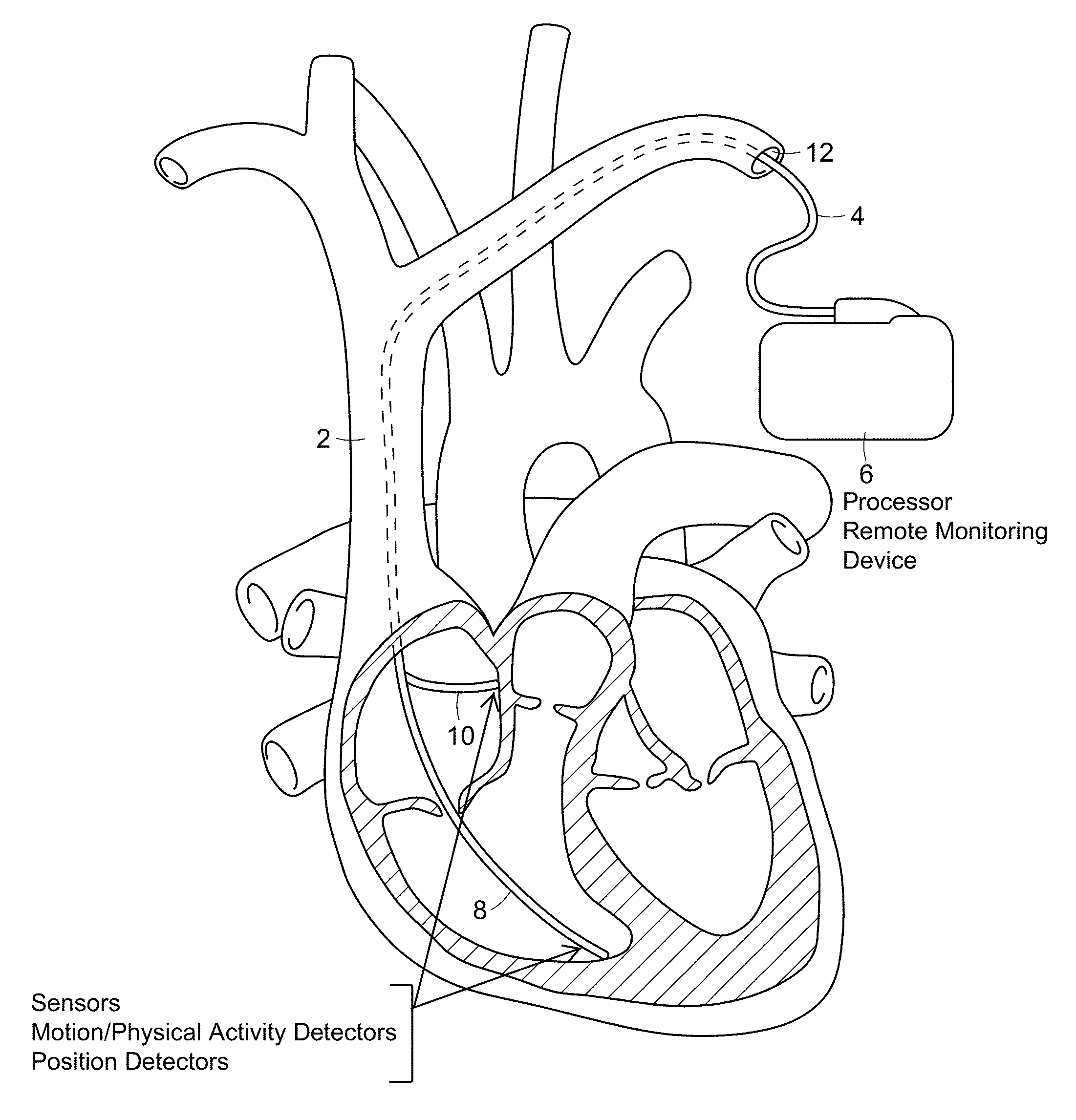 Cardiac pacemaker and uses thereof