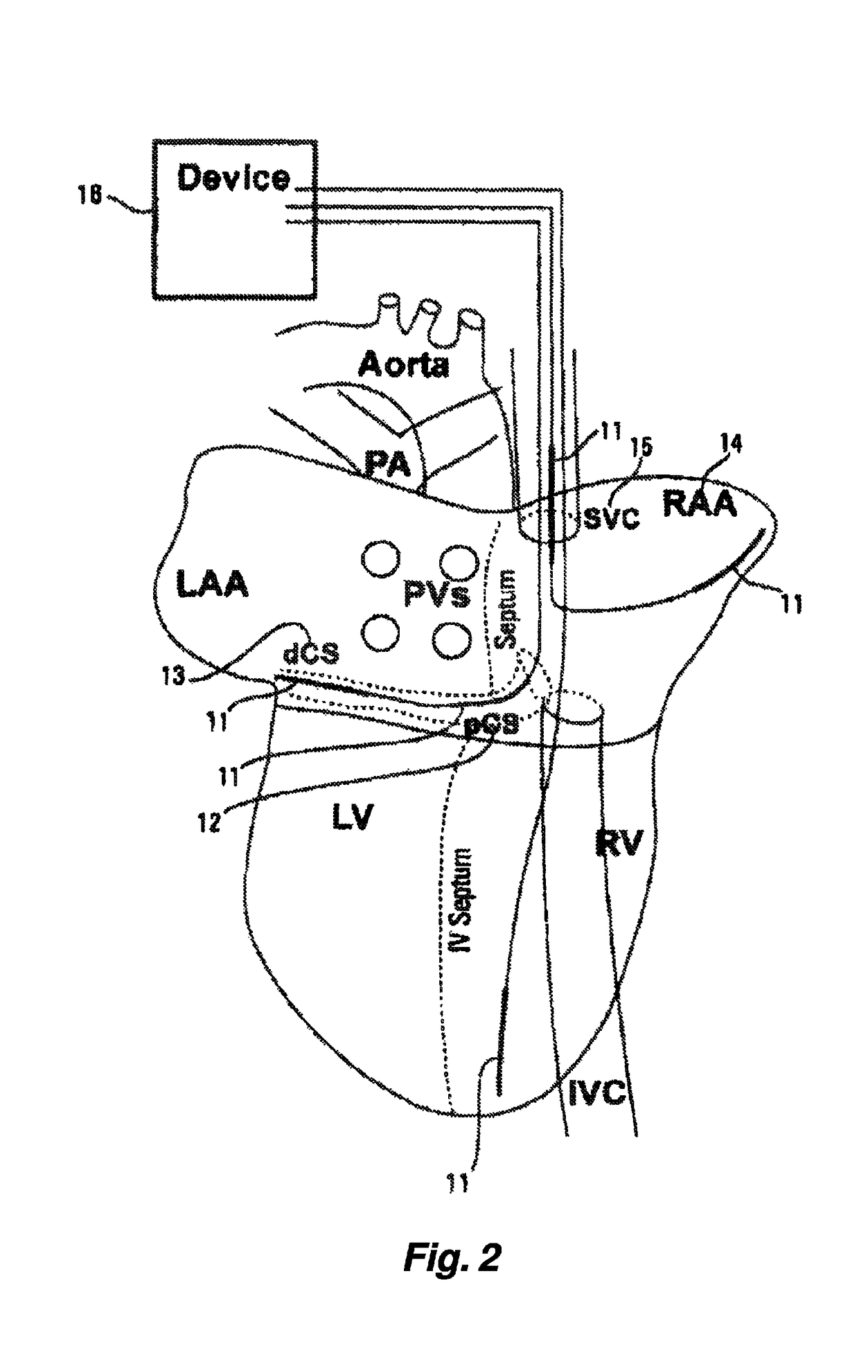 Low-energy atrial cardioversion therapy with controllable pulse-shaped waveforms