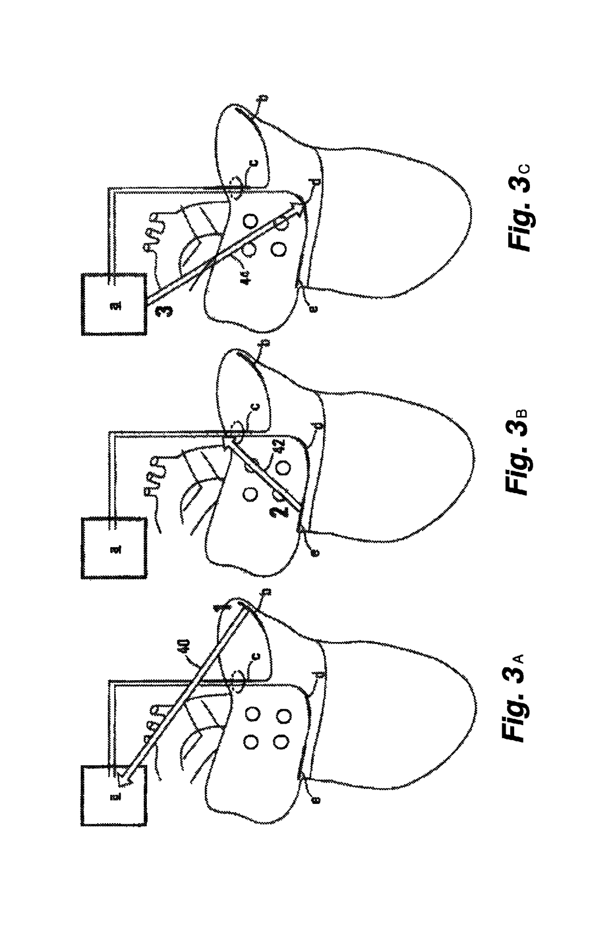 Low-energy atrial cardioversion therapy with controllable pulse-shaped waveforms