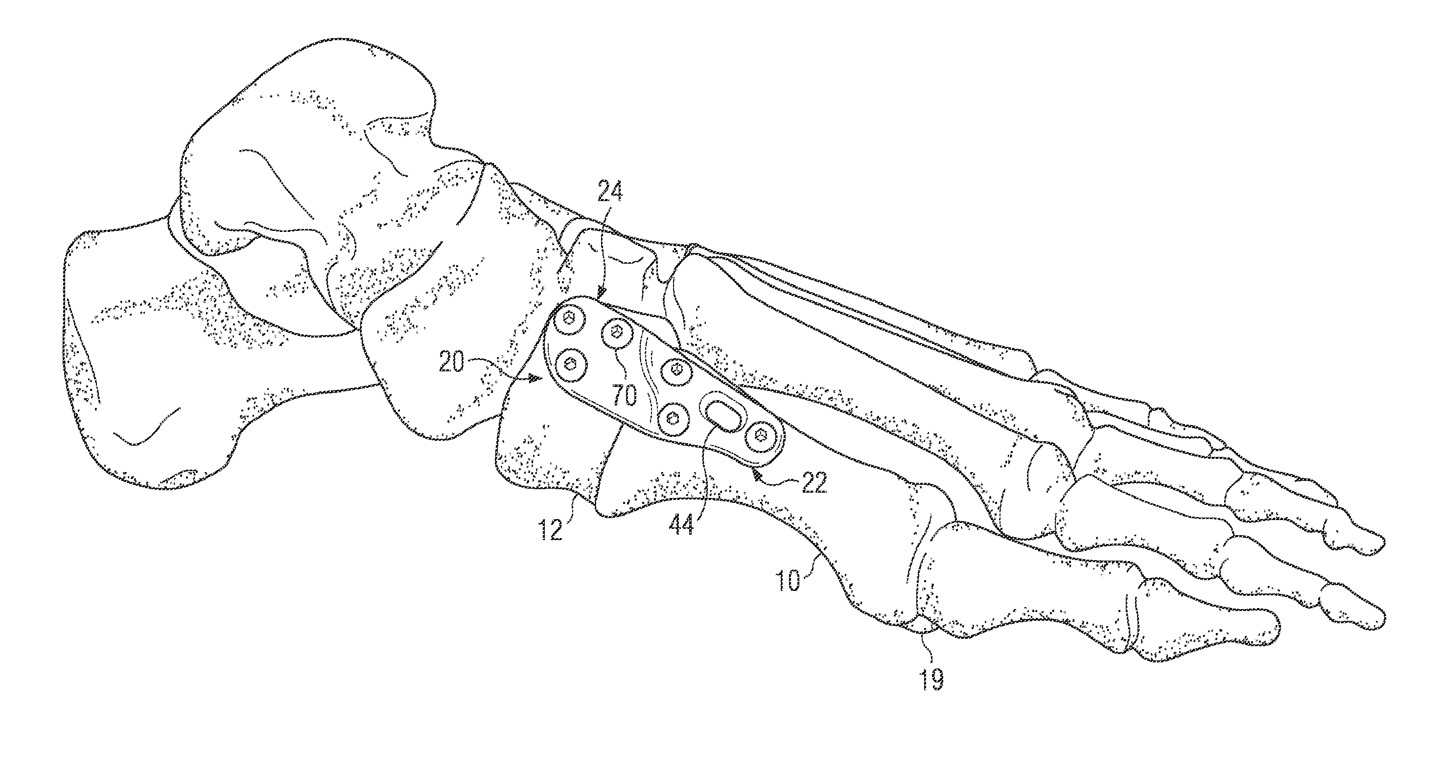 Fixation plate for use in the lapidus approach