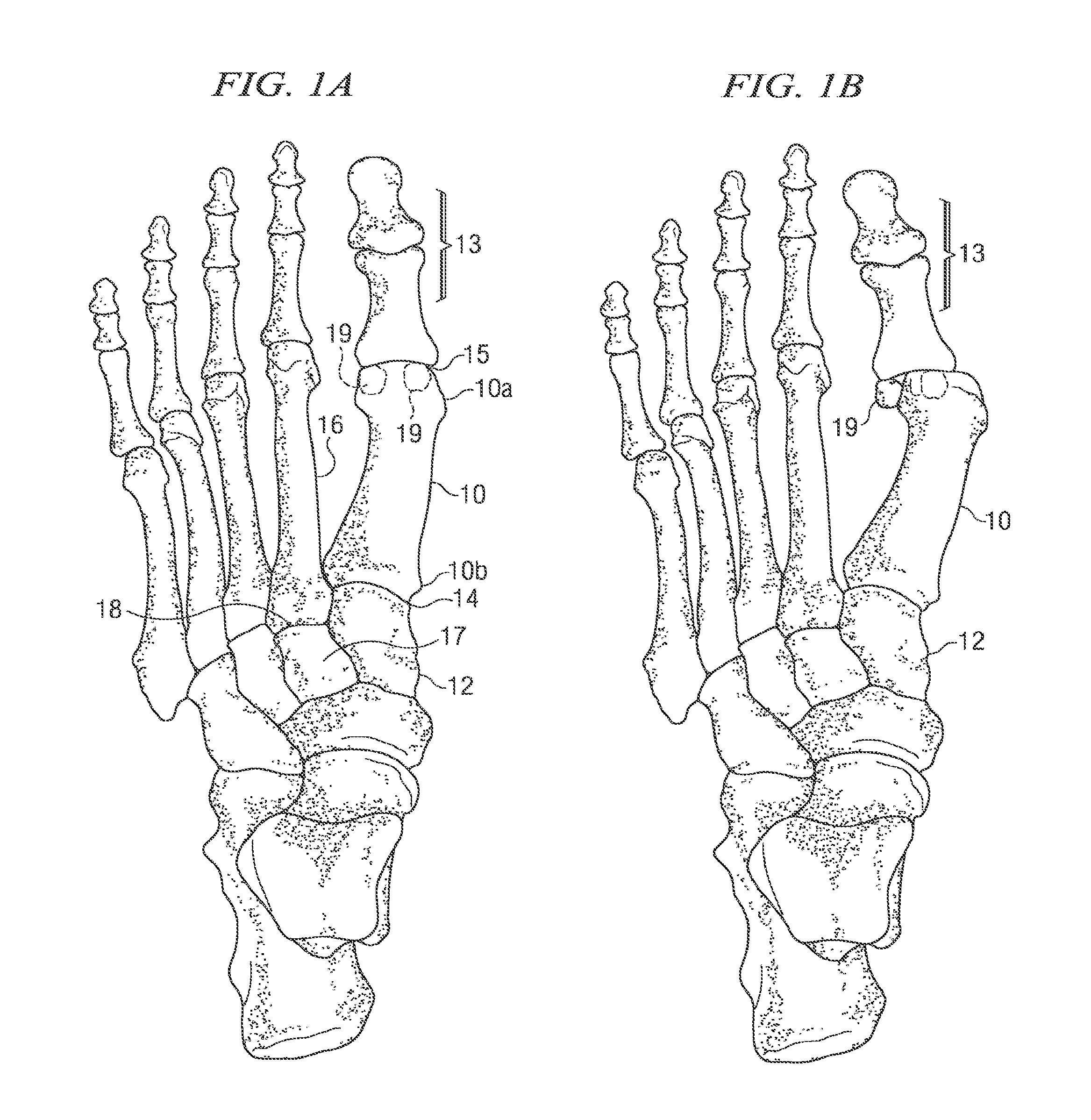 Fixation plate for use in the lapidus approach