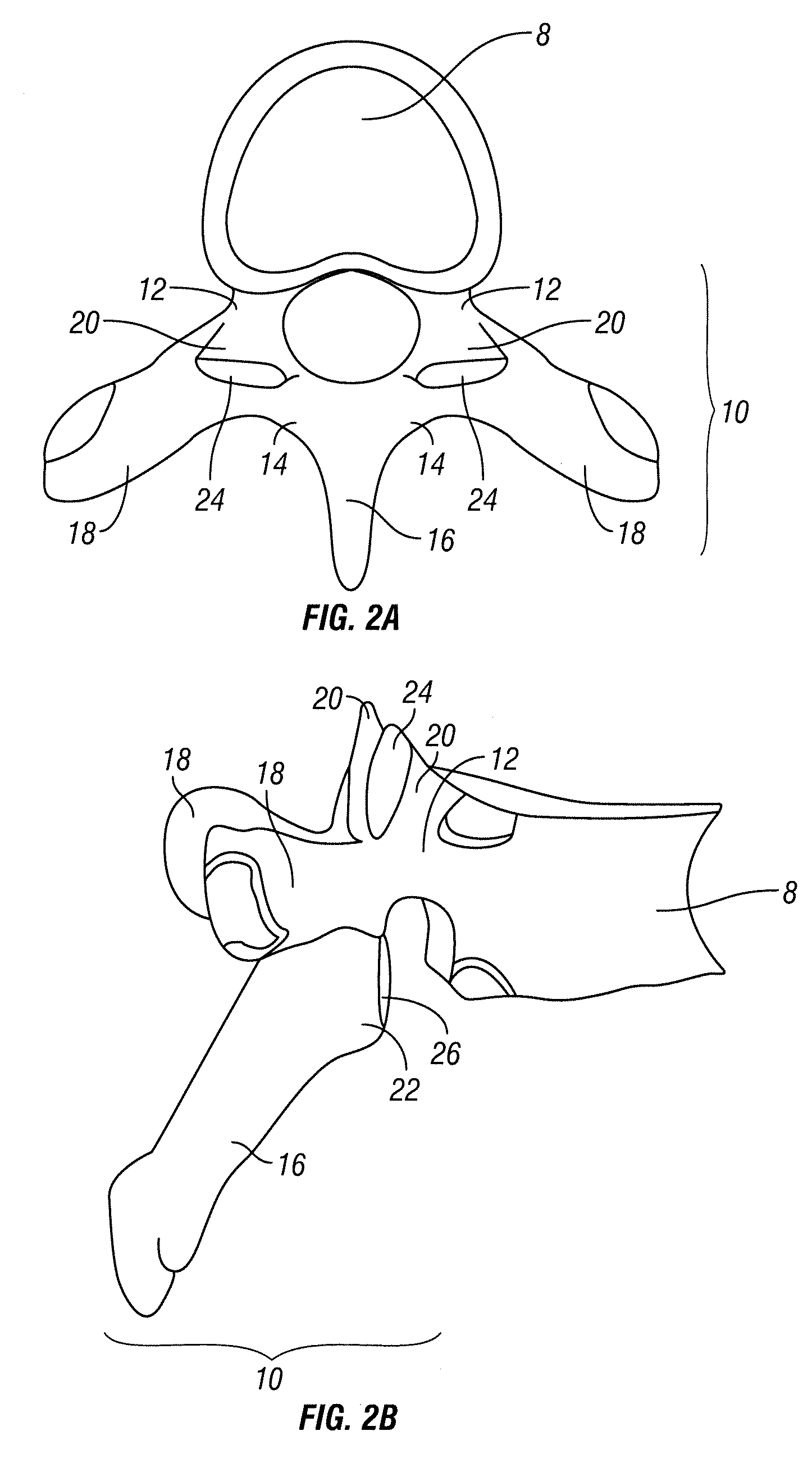 Implant and method for facet immobilization