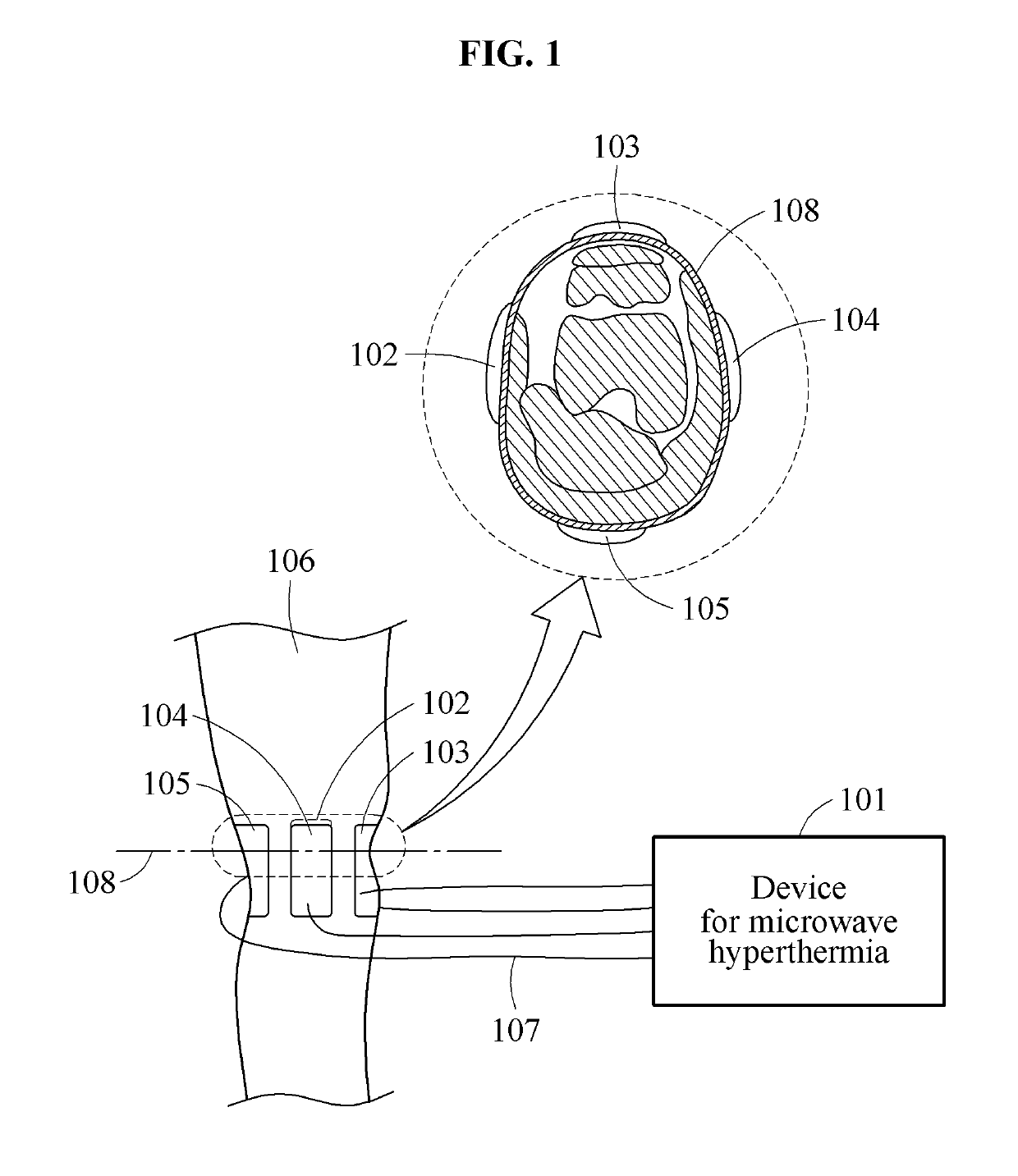 Apparatus for microwave hyperthermia