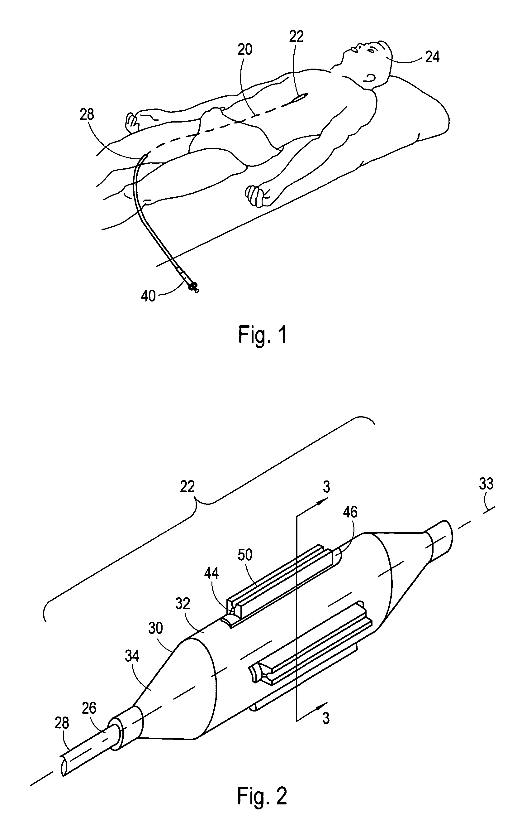 Cutting balloon having sheathed incising elements