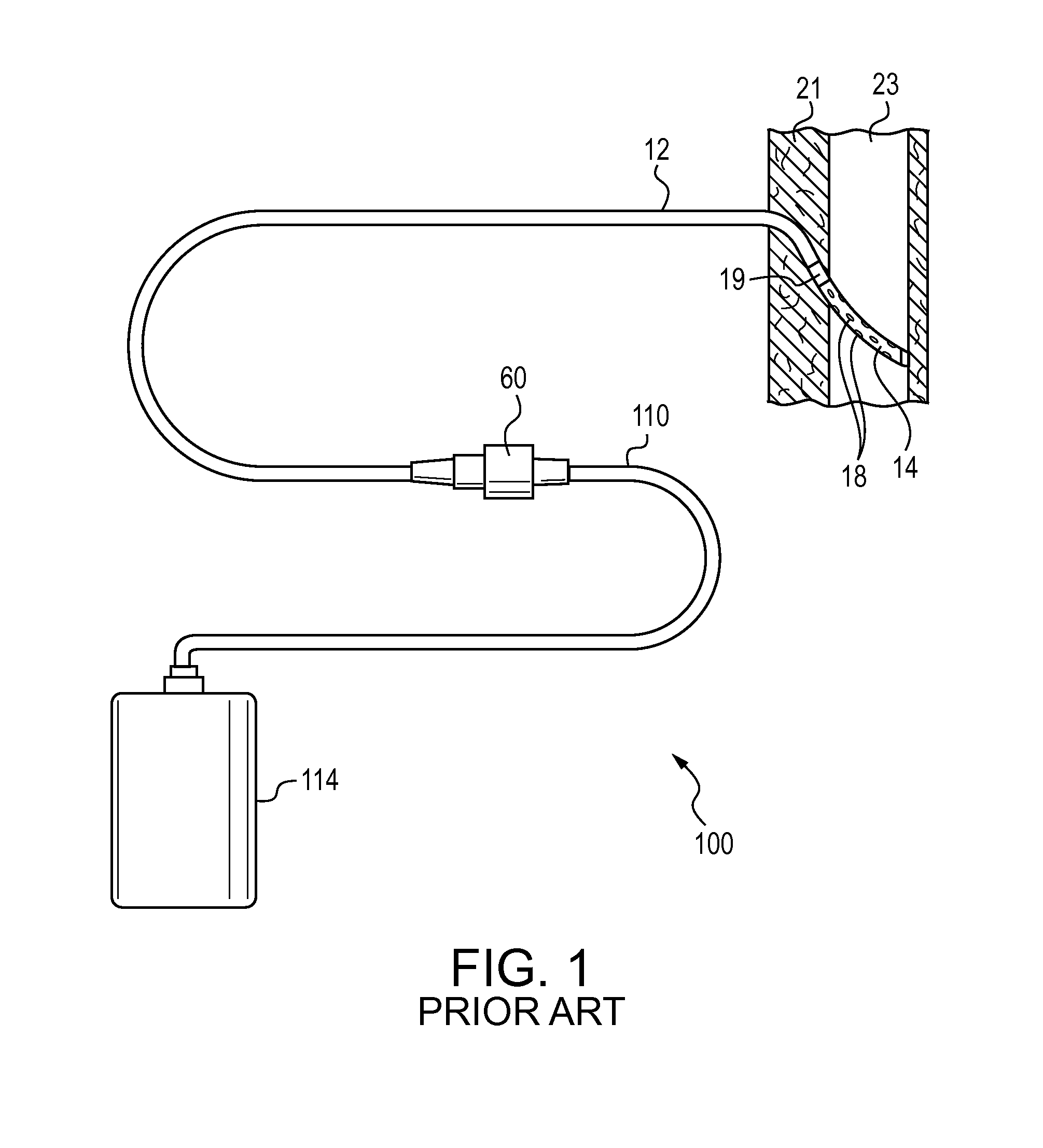 Pleurodesis device and method