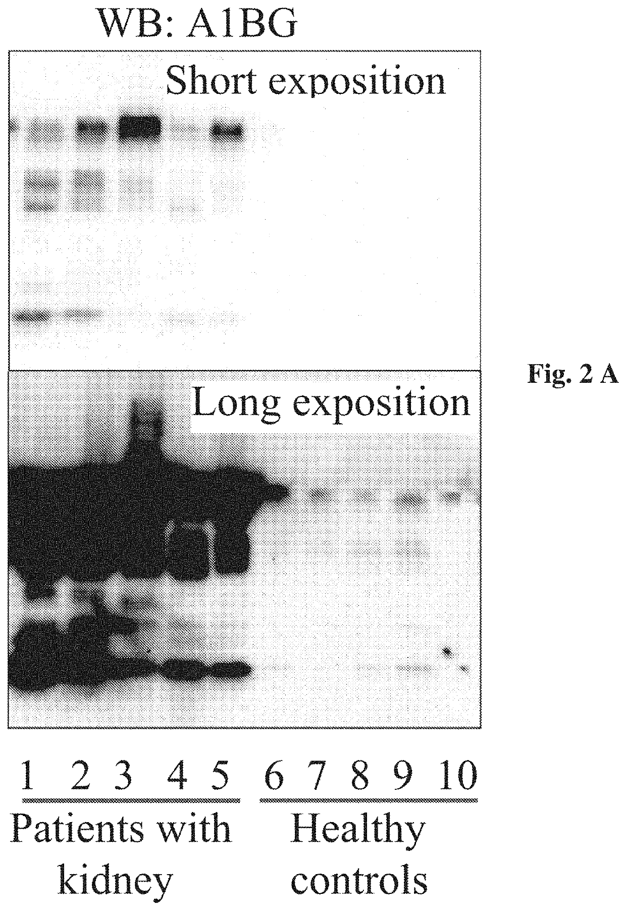 Methods for diagnosis, differentiation and monitoring using urine proteins as markers in iga nephropathy