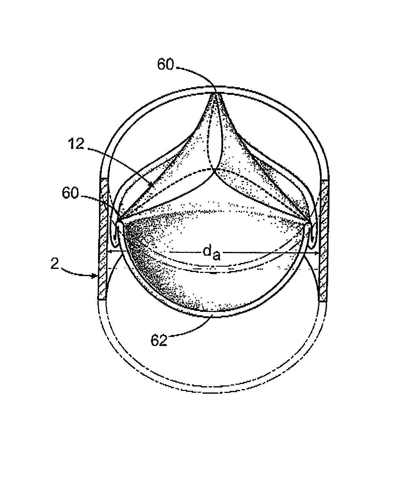 Prosthetic tissue valve