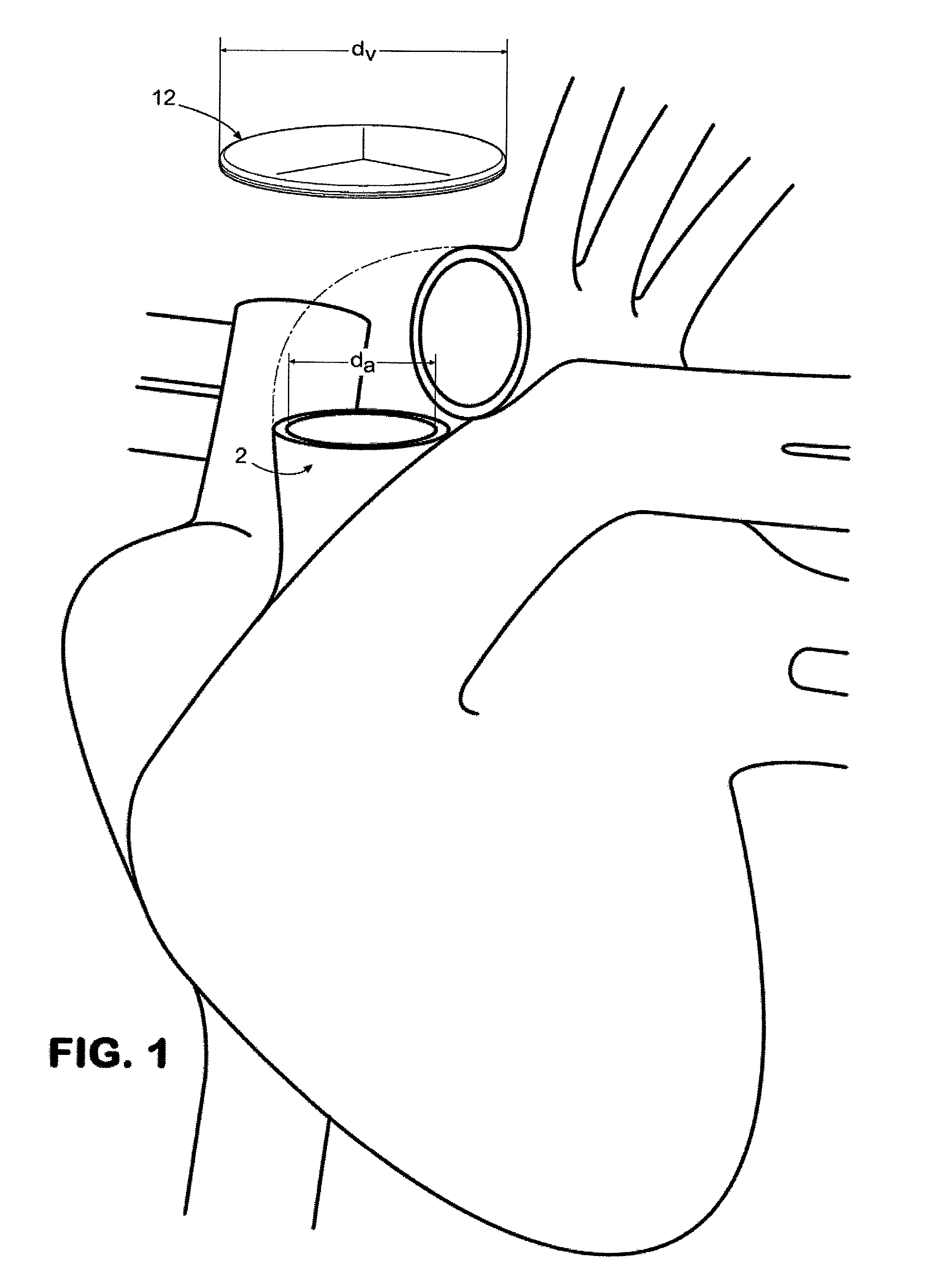 Prosthetic tissue valve