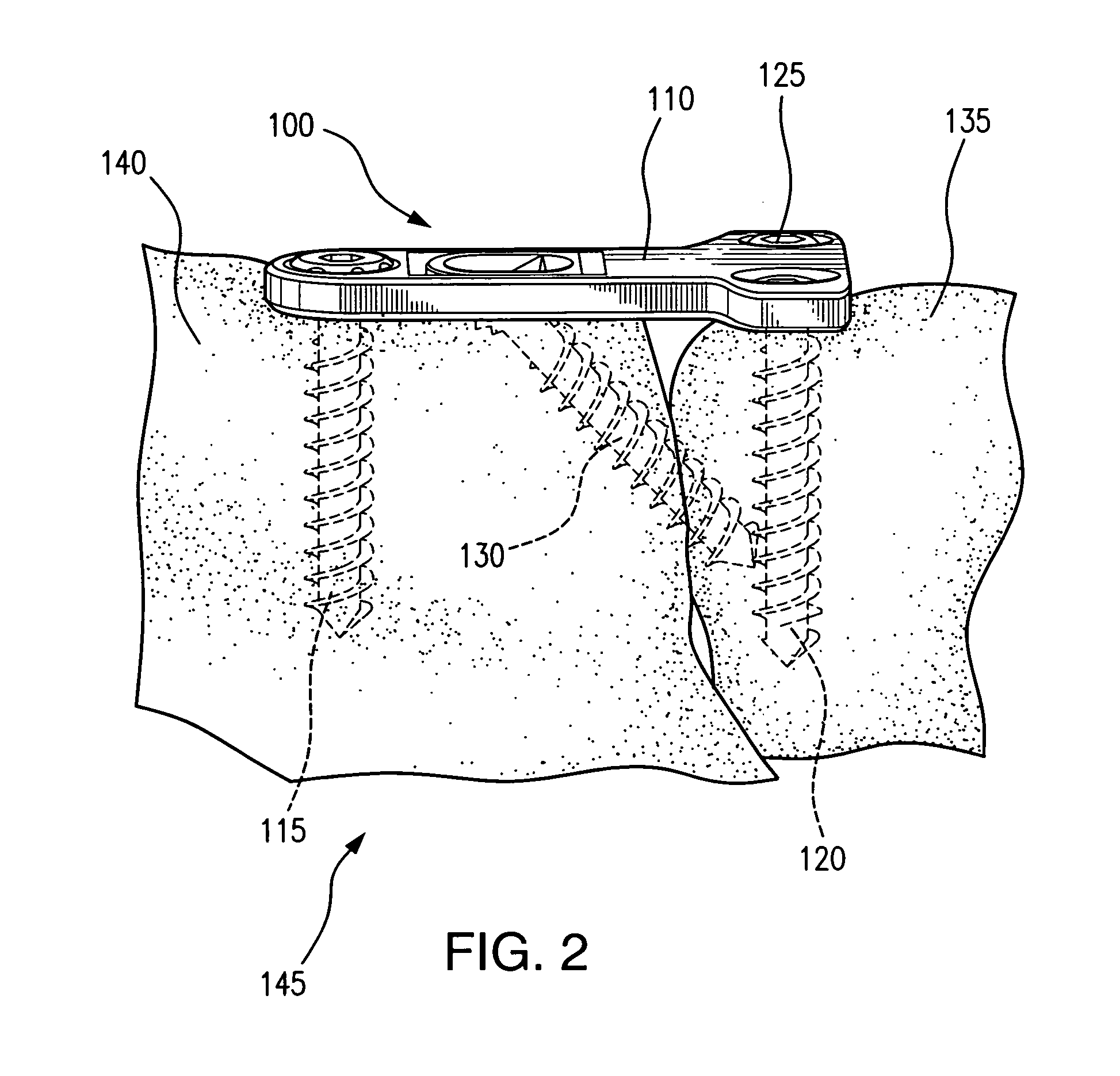 Tabbed compression plate and method of use