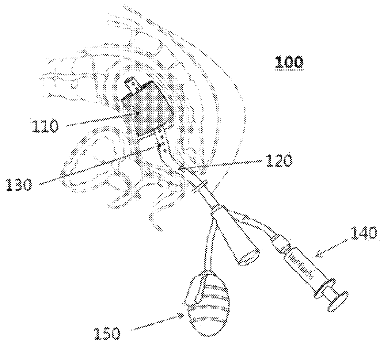 Device for protecting the rectal anastomosis