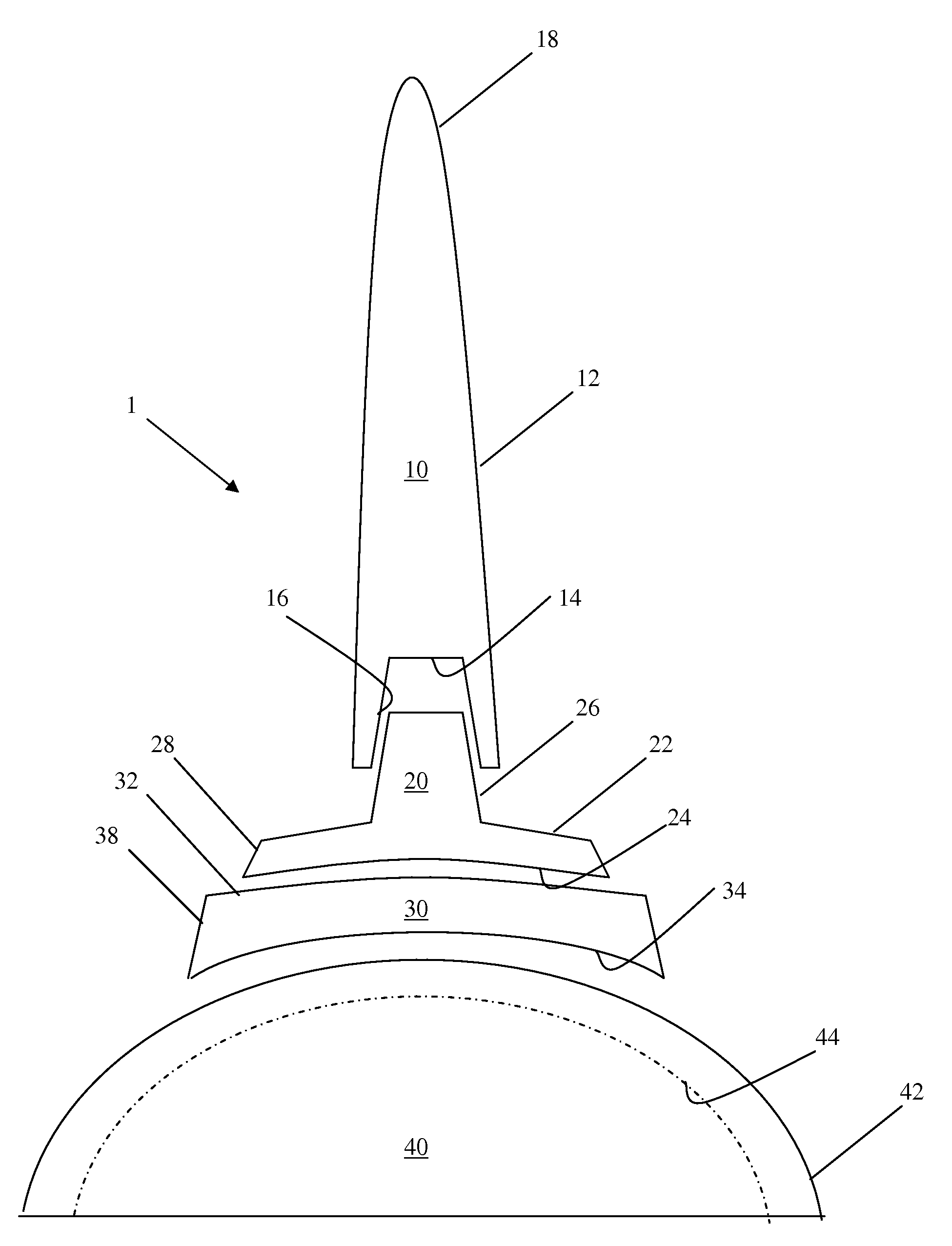 Iliac canal prosthesis