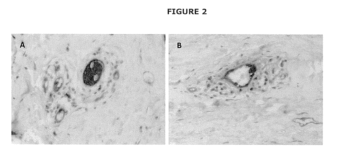 Treatment of fibrotic conditions