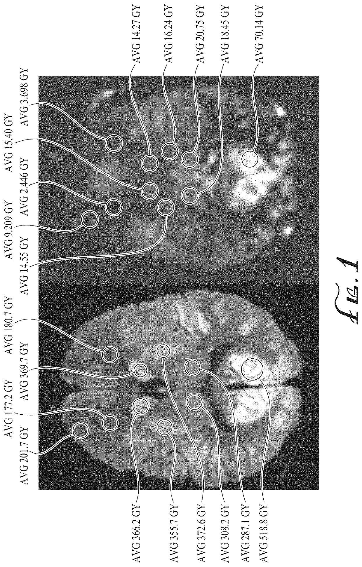 Imaging biomarkers based on ratio between diffusion and perfusion