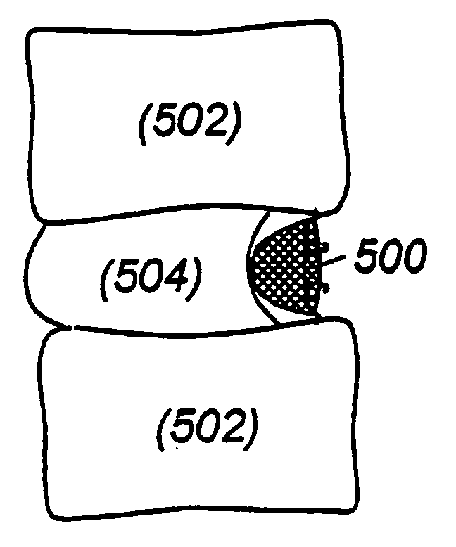 Methods and apparatus for treating disc herniation and preventing the extrusion of interbody bone graft