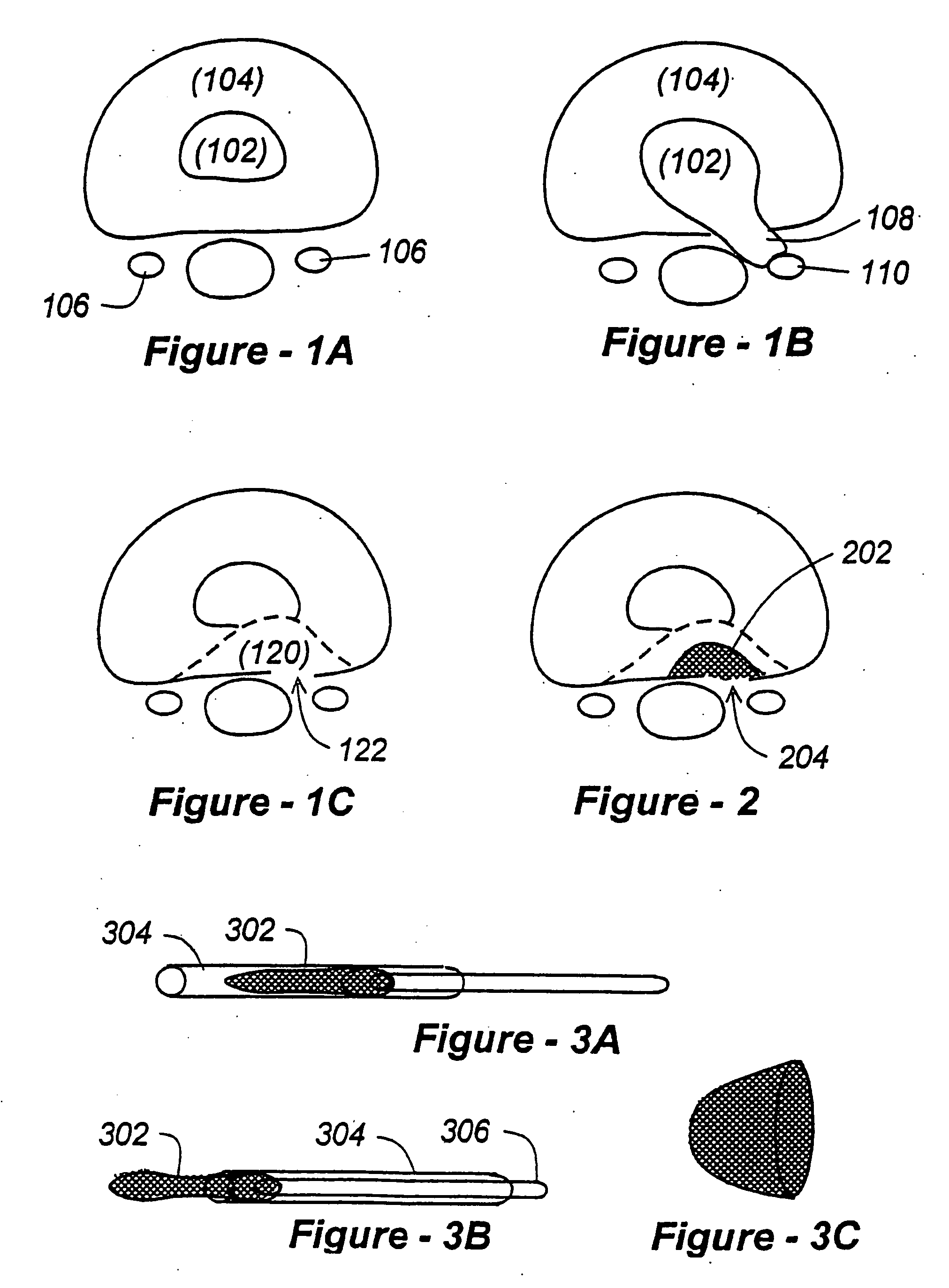 Methods and apparatus for treating disc herniation and preventing the extrusion of interbody bone graft