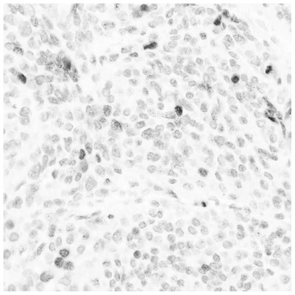 Application of BUB1 protein in preparation of high-grade meningioma prognosis evaluation reagent or kit