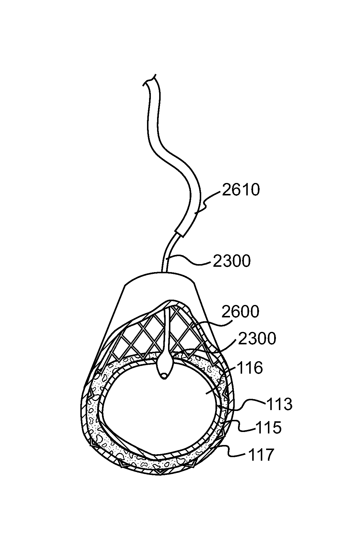 Endovascular devices and methods for exploiting intramural space