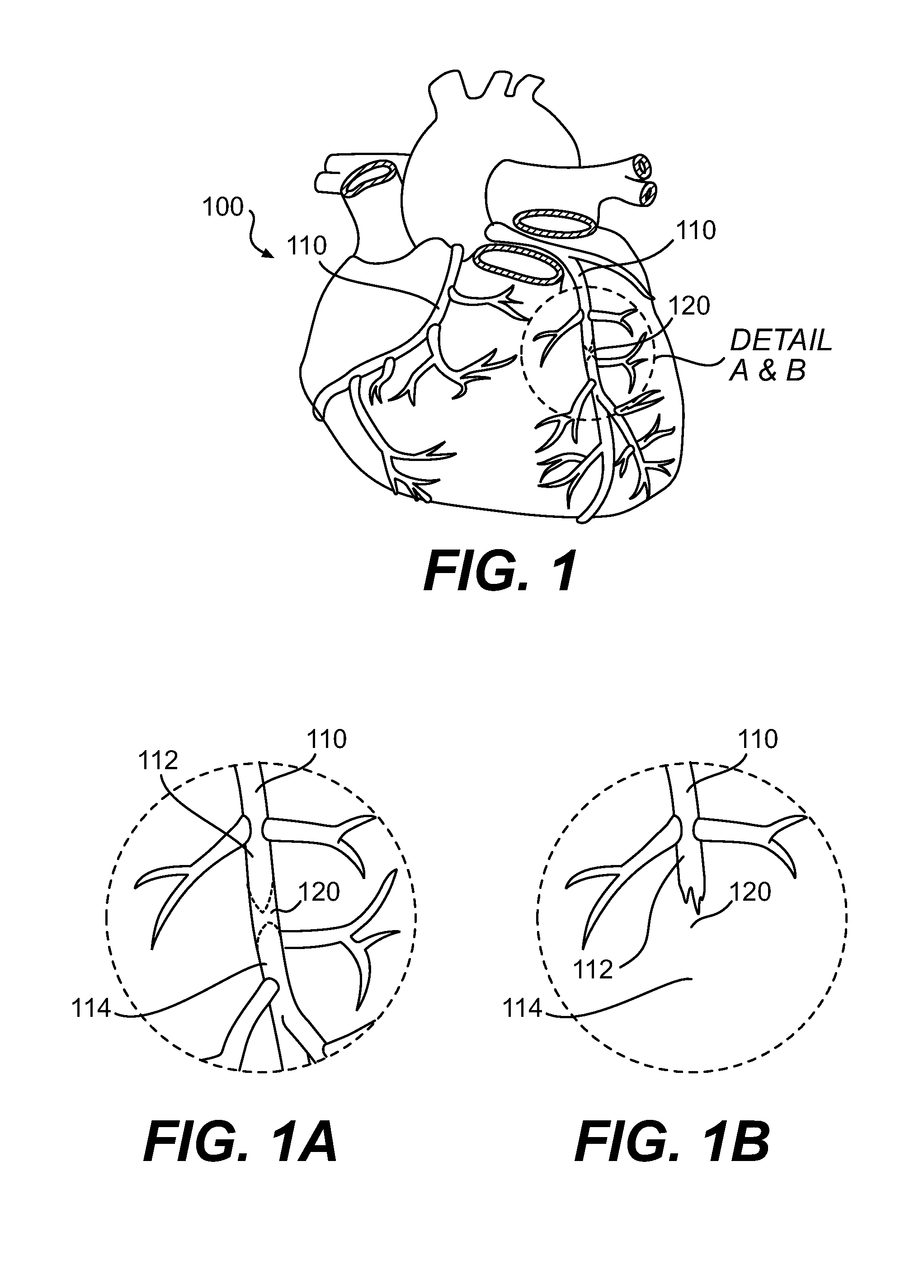 Endovascular devices and methods for exploiting intramural space