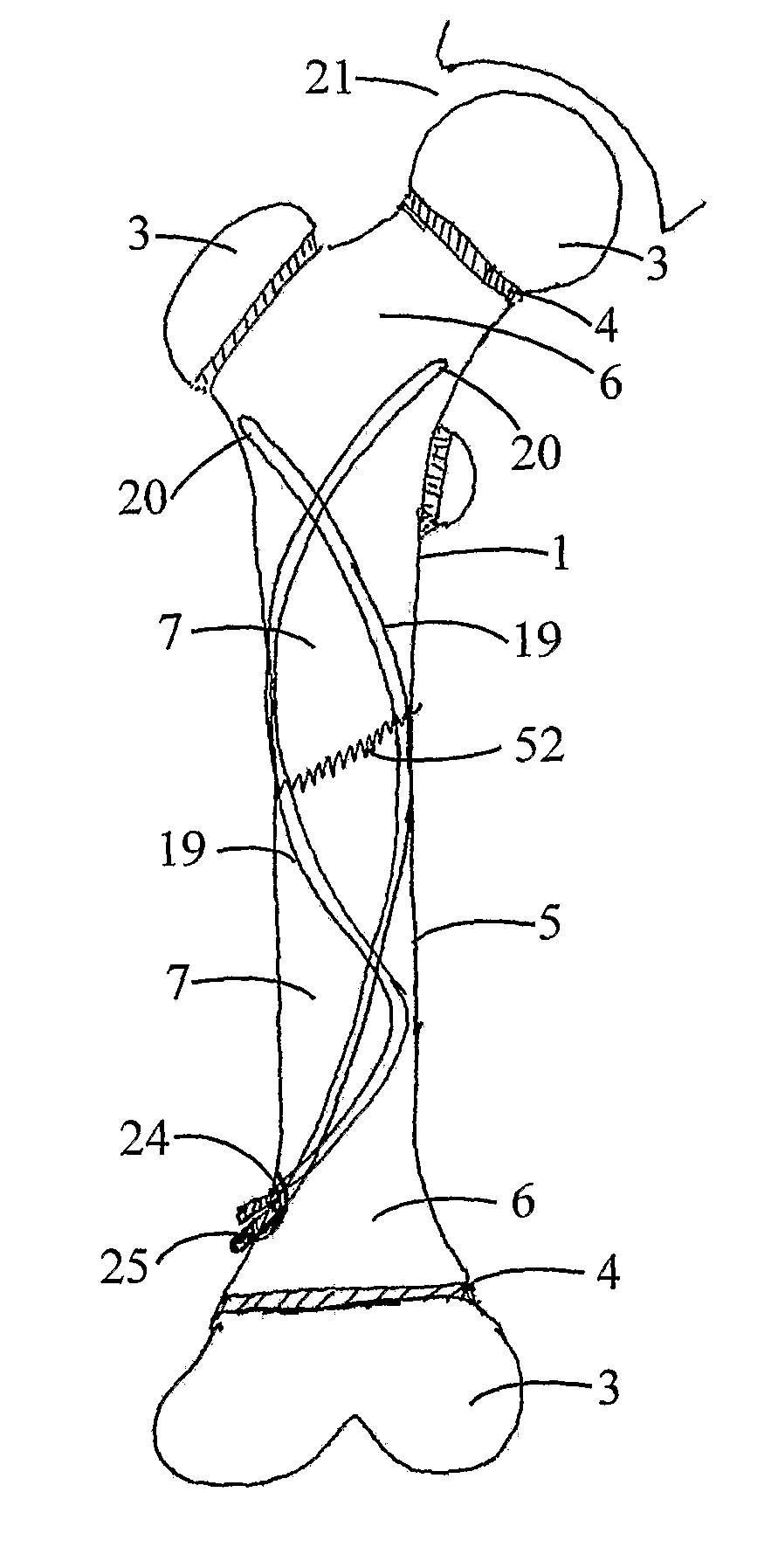 Flexible Nail Assembly For Fractures Of Long Bones