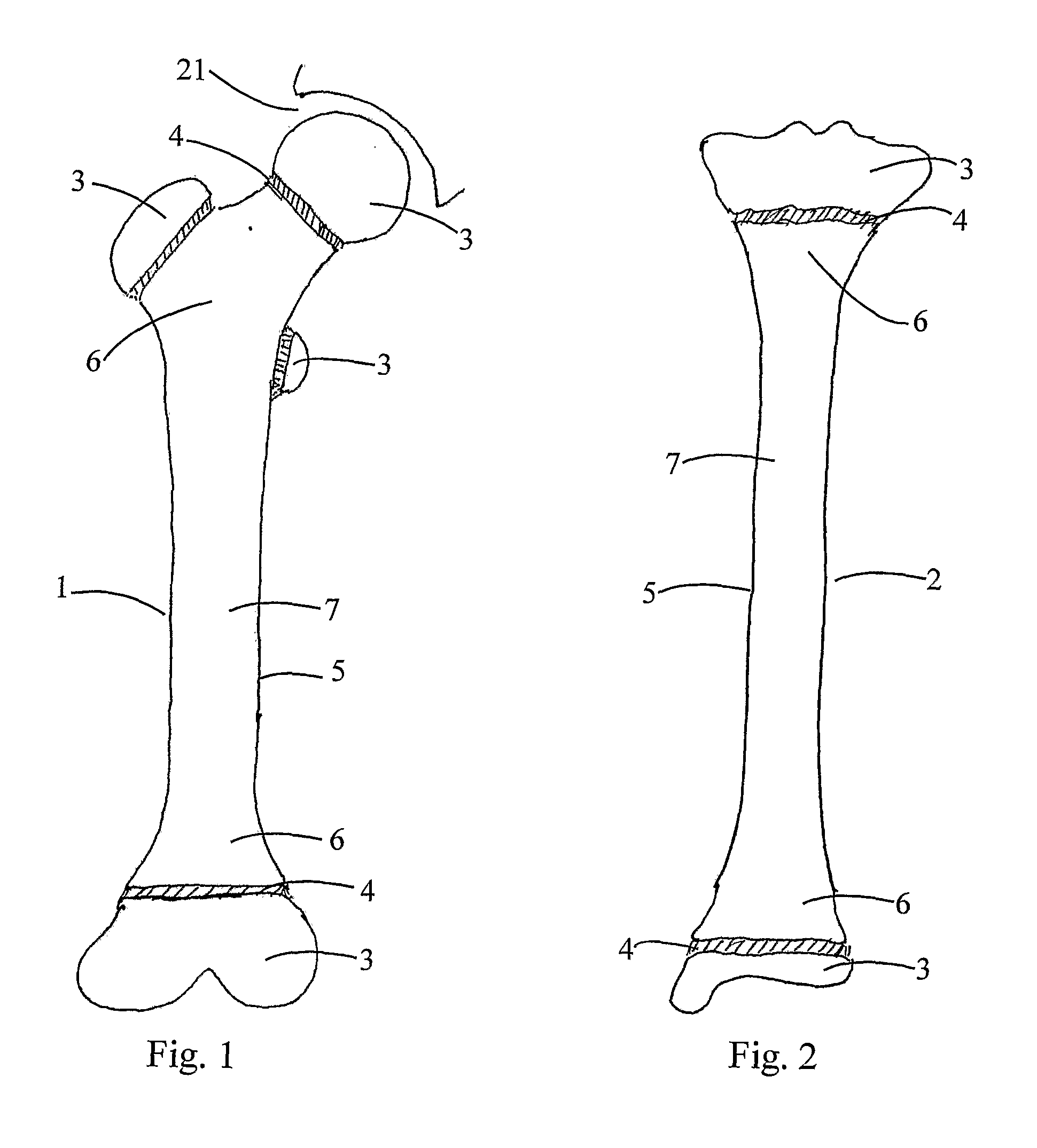 Flexible Nail Assembly For Fractures Of Long Bones