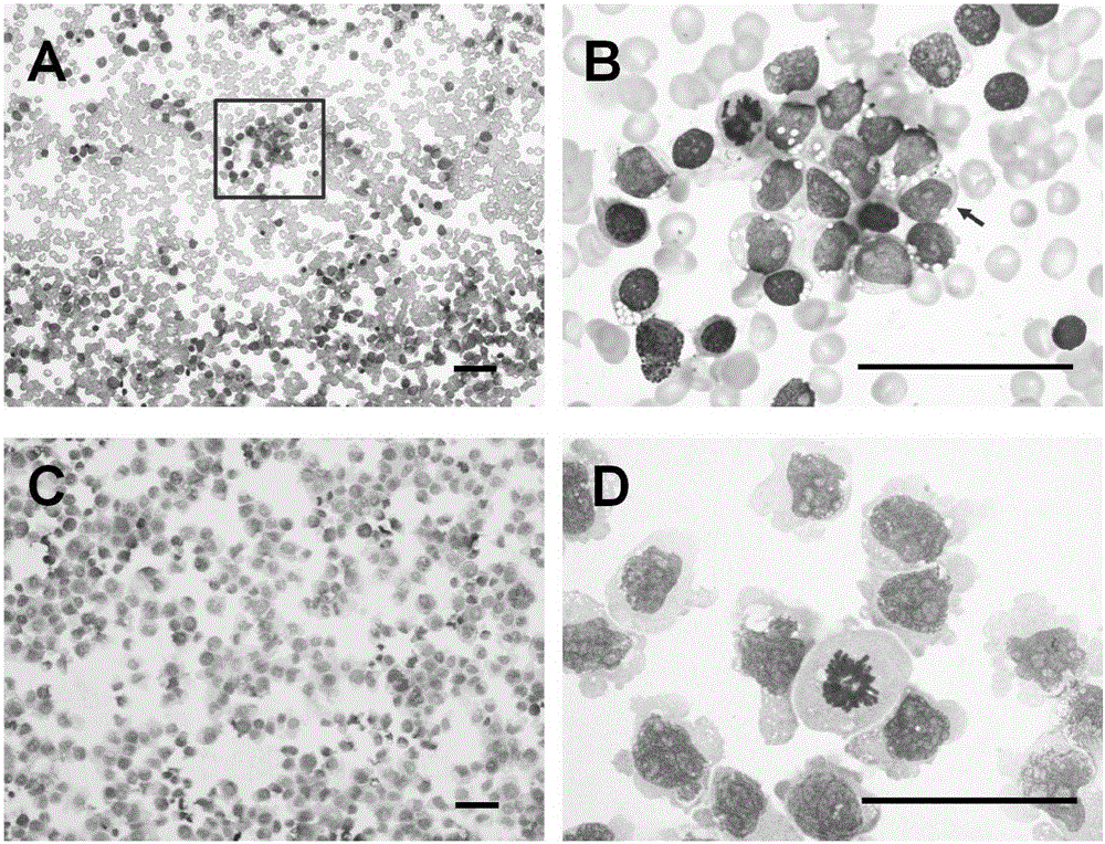 Highly aggressive human acute B lymphocytic leukemia cell strain with add(11)(q23) chromosome abnormality