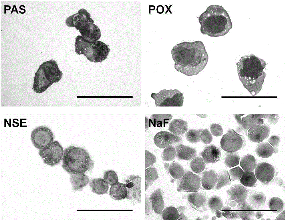 Highly aggressive human acute B lymphocytic leukemia cell strain with add(11)(q23) chromosome abnormality