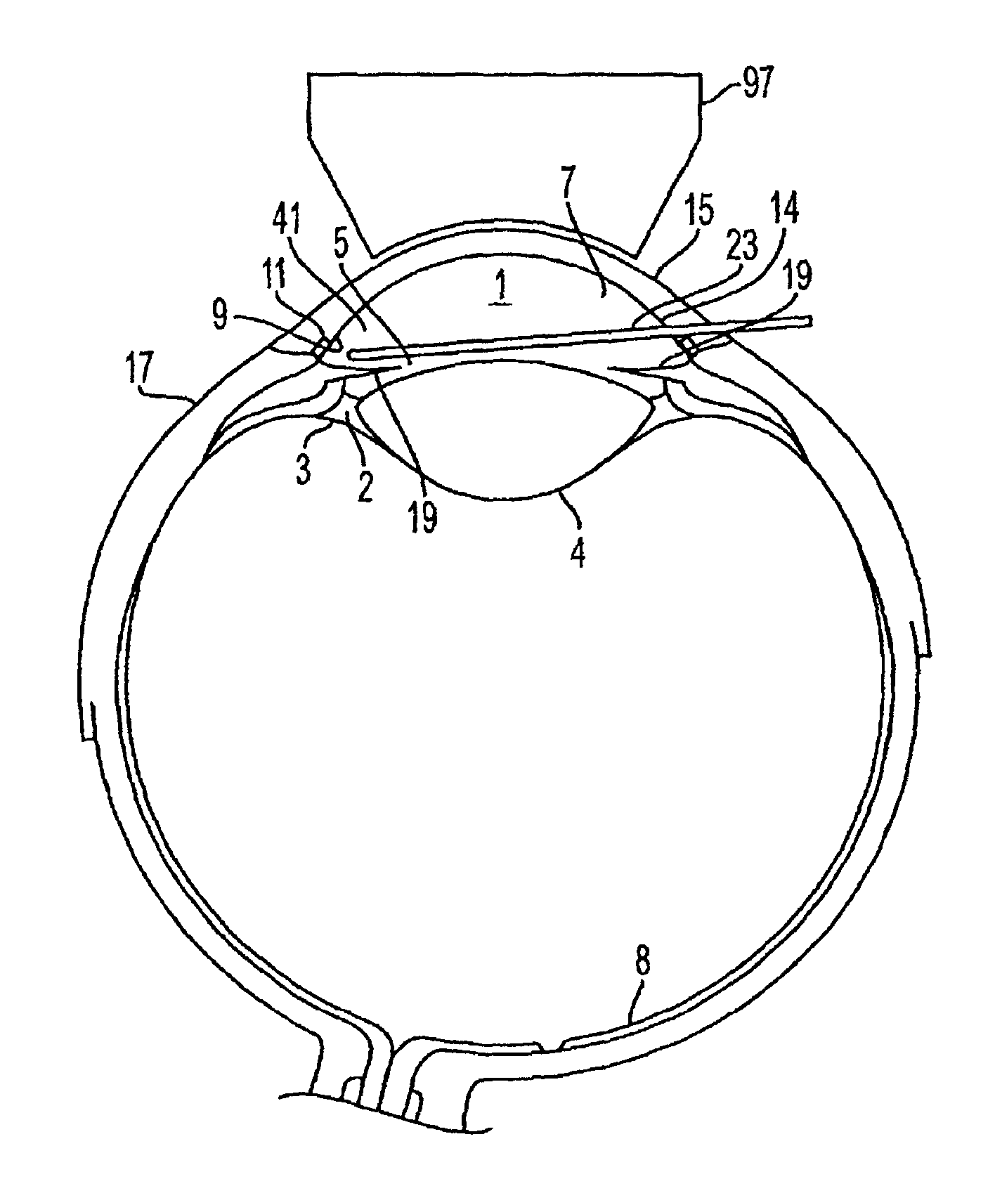 Glaucoma surgery methods and systems