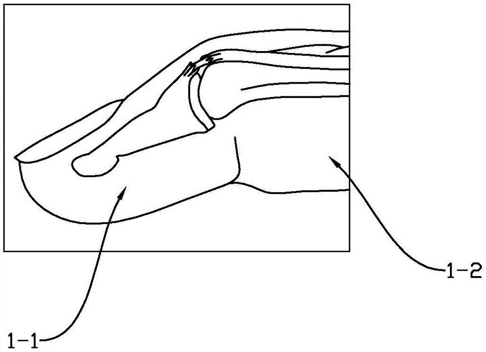 Hammer finger orthopedic appliance