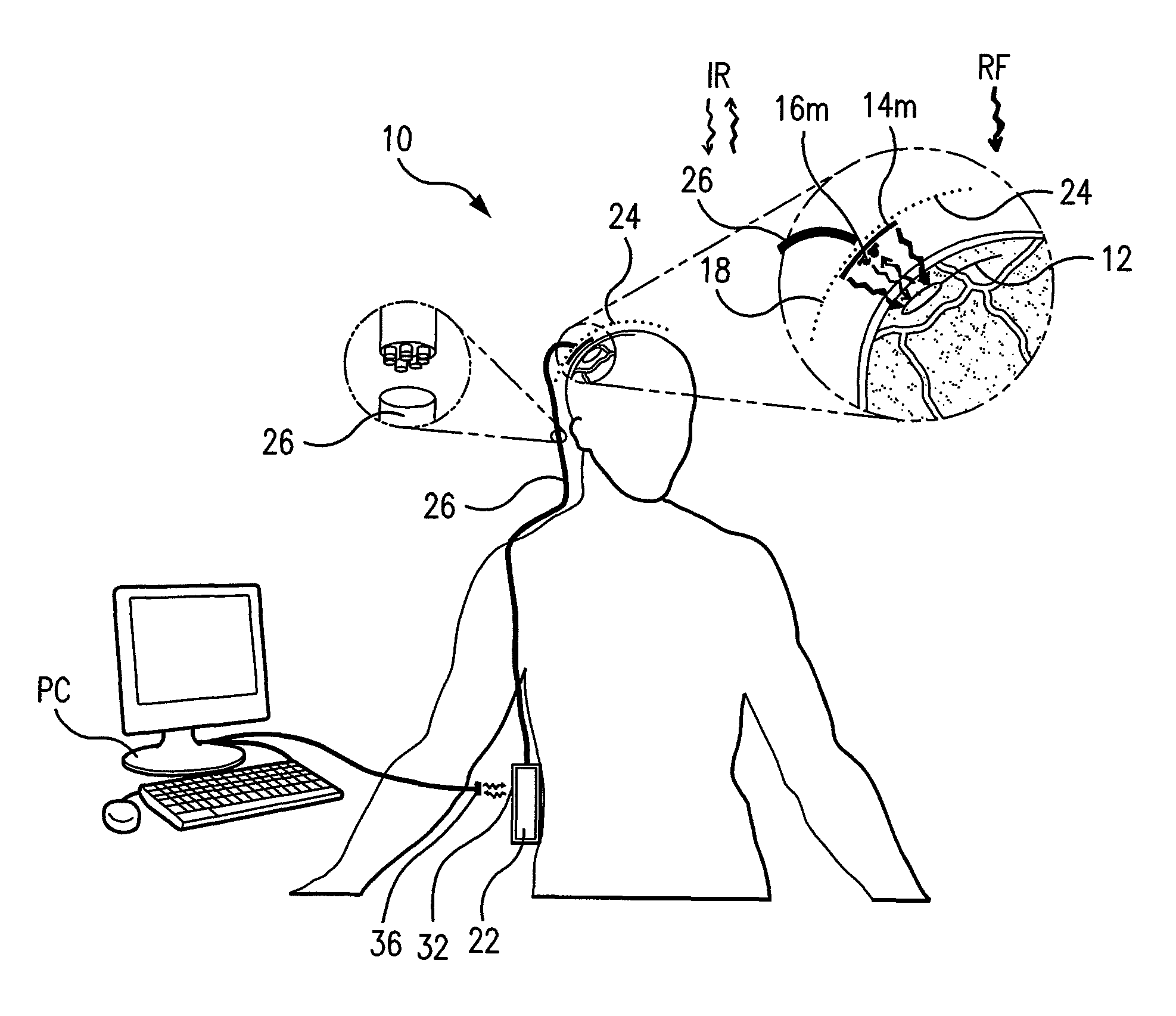 Wireless system for epilepsy monitoring and measurement