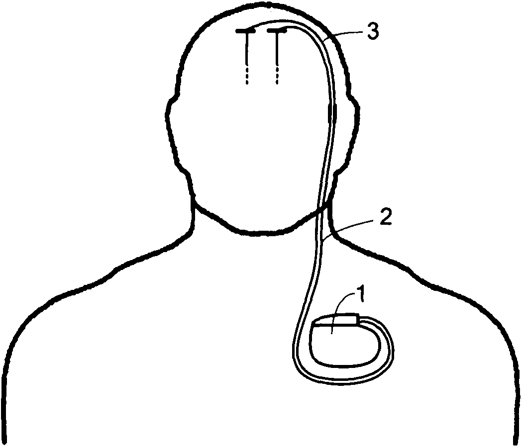 Deep brain electric stimulation system implanted in head