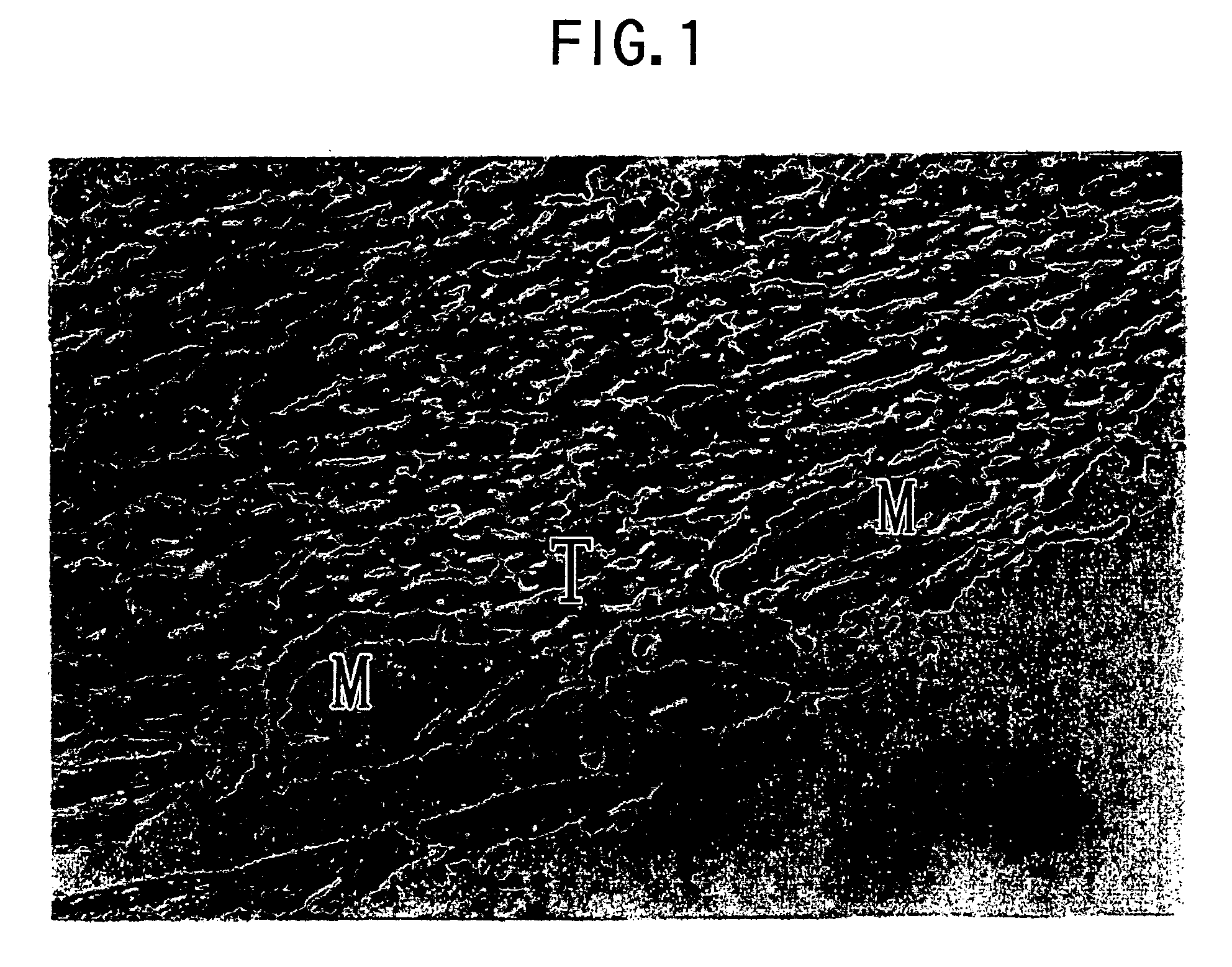 Preparation comprising batroxobin for inhibiting local invasion of malignant tumors