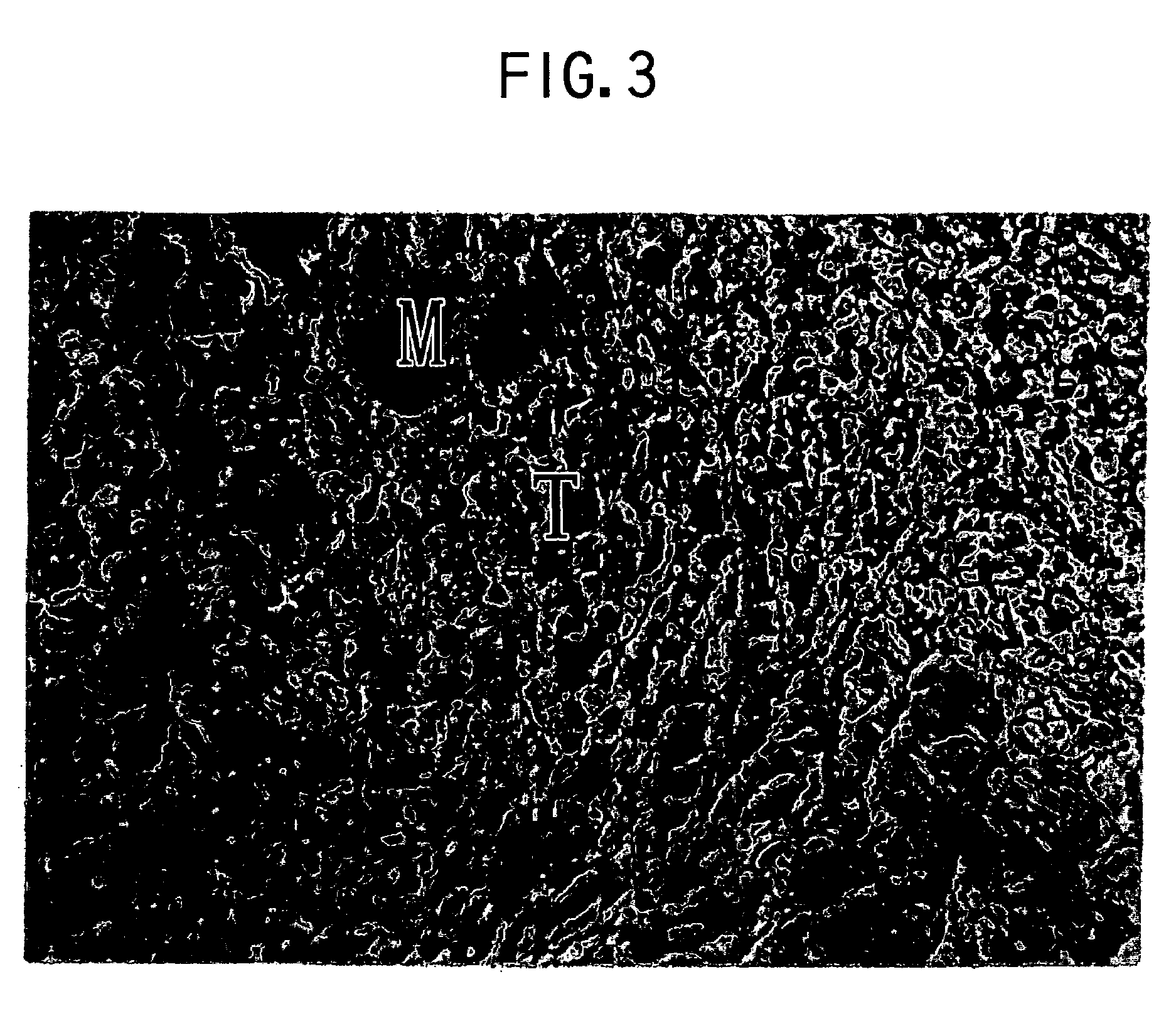 Preparation comprising batroxobin for inhibiting local invasion of malignant tumors