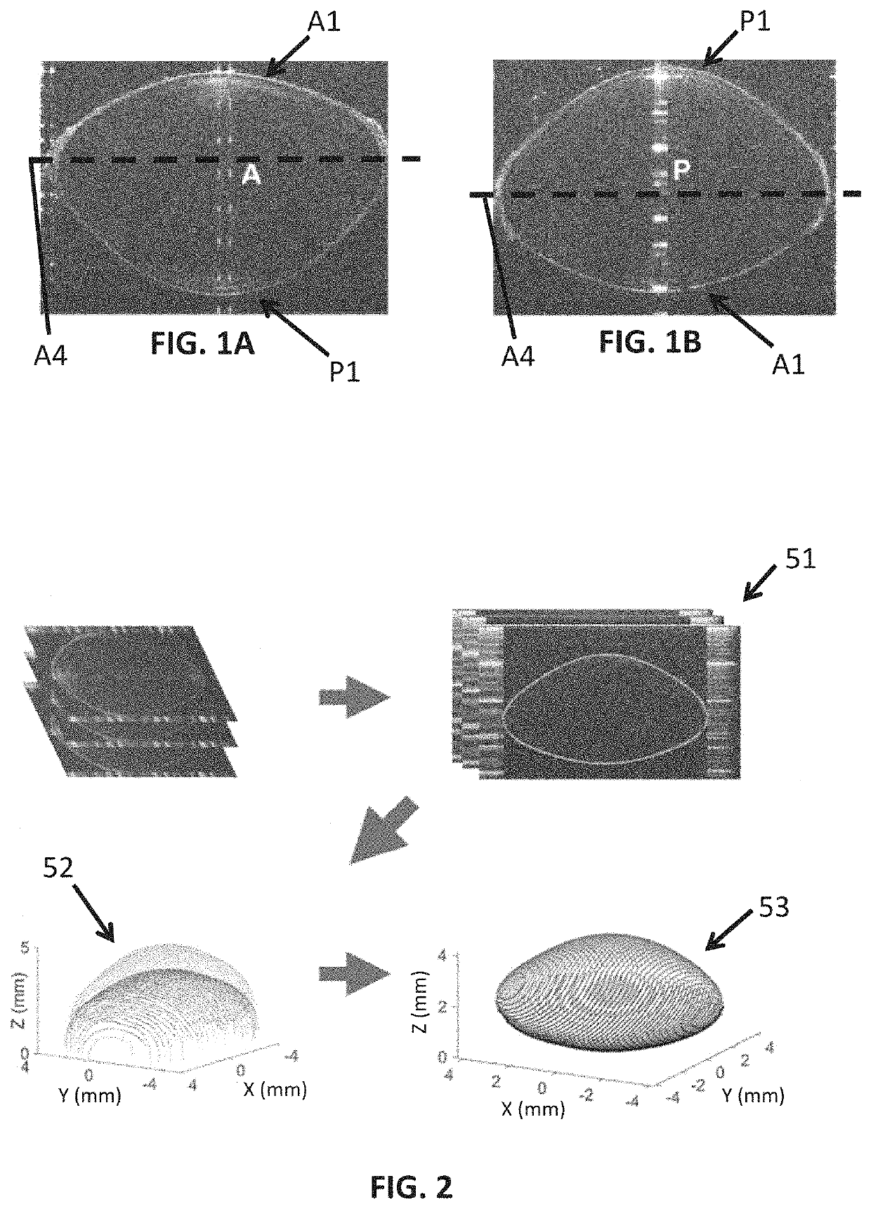 Method of estimating a full shape of the crystalline lens from measurements taken by optic imaging techniques and method of estimating an intraocular lens position in a cataract surgery