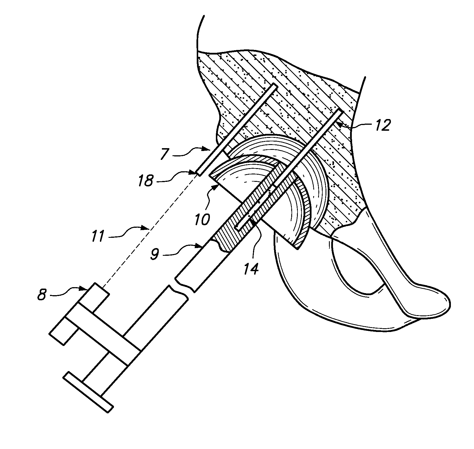 Device and method for achieving accurate positioning of acetabular cup during total hip replacement