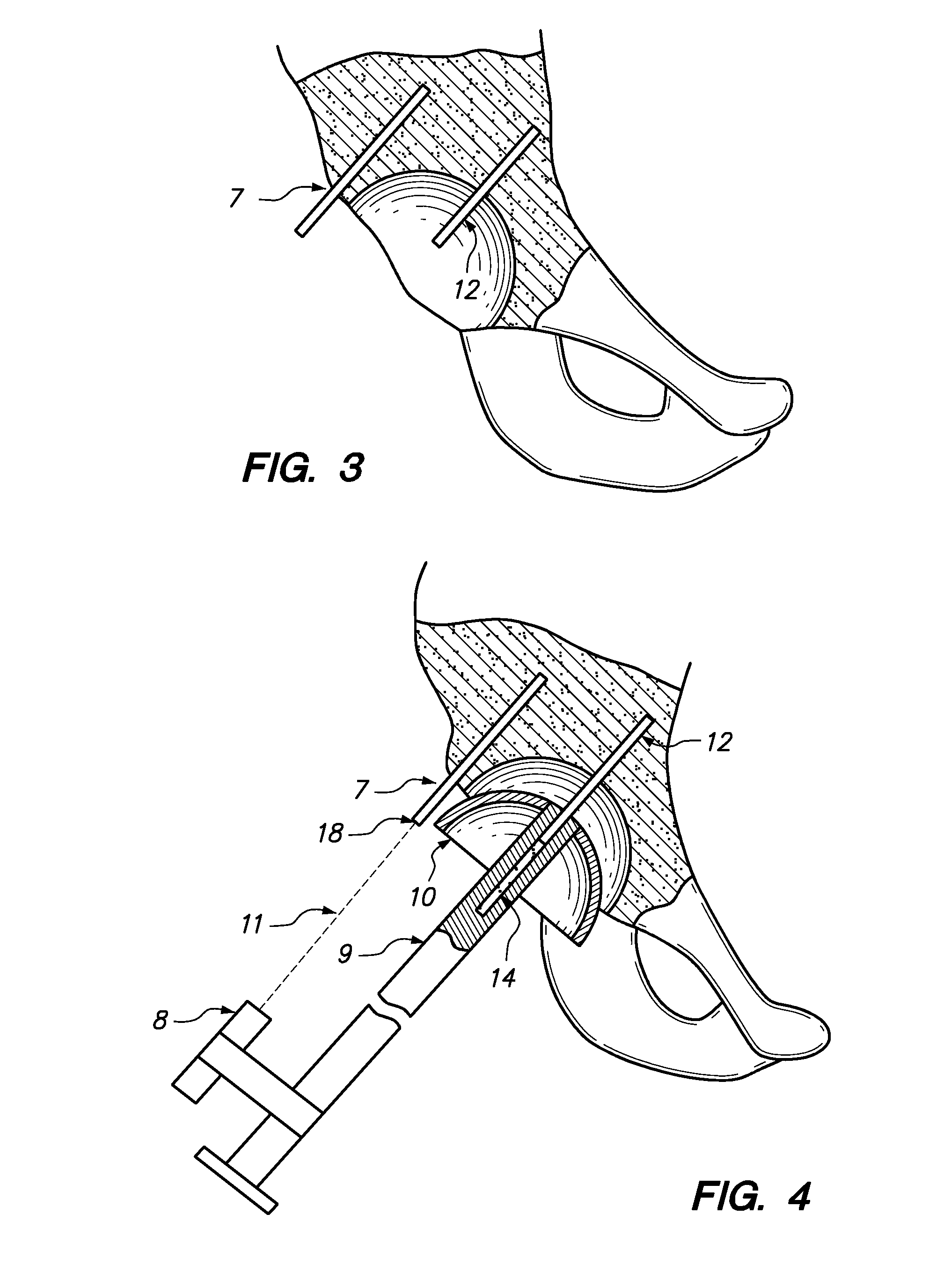 Device and method for achieving accurate positioning of acetabular cup during total hip replacement