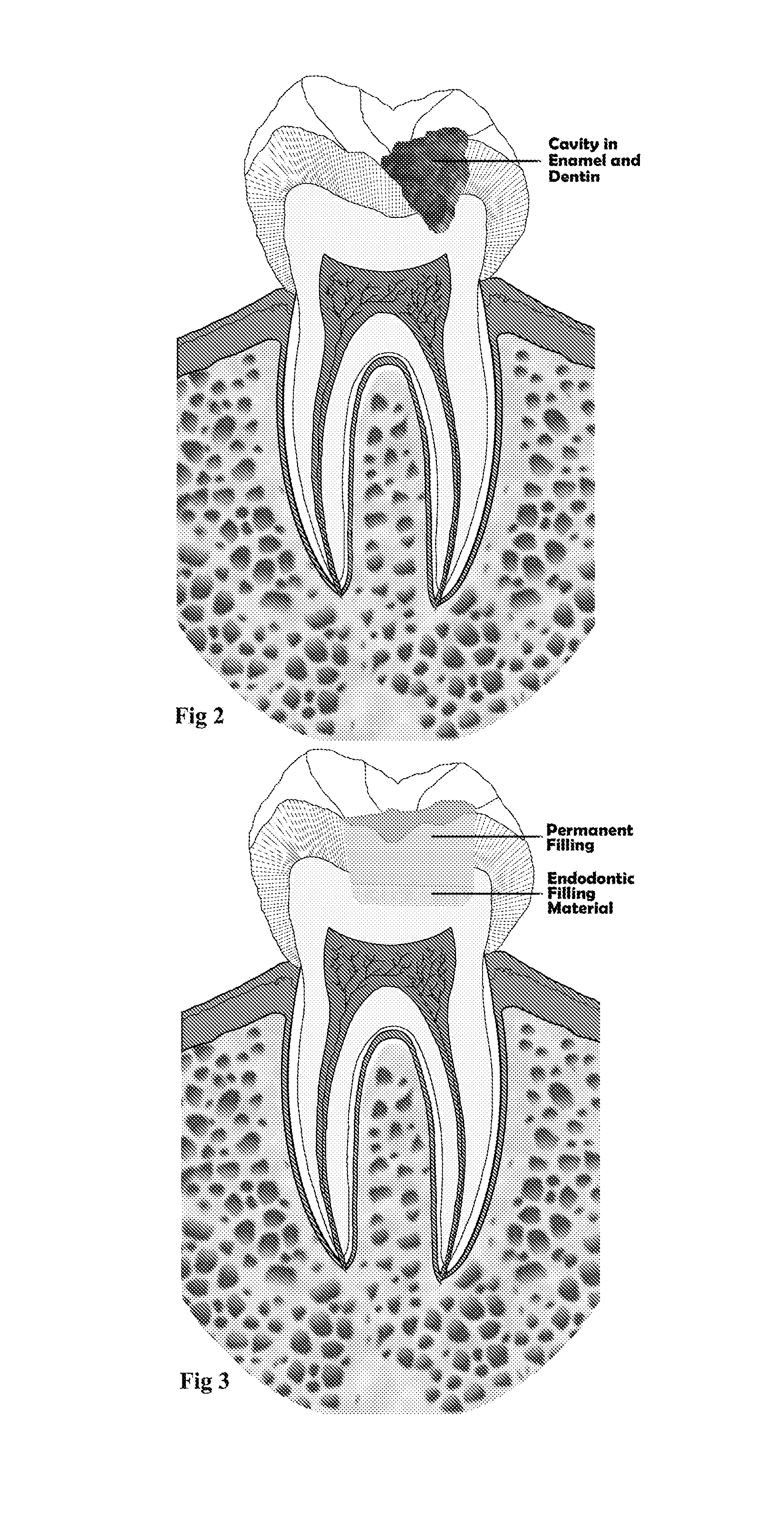 Endodontic filling material