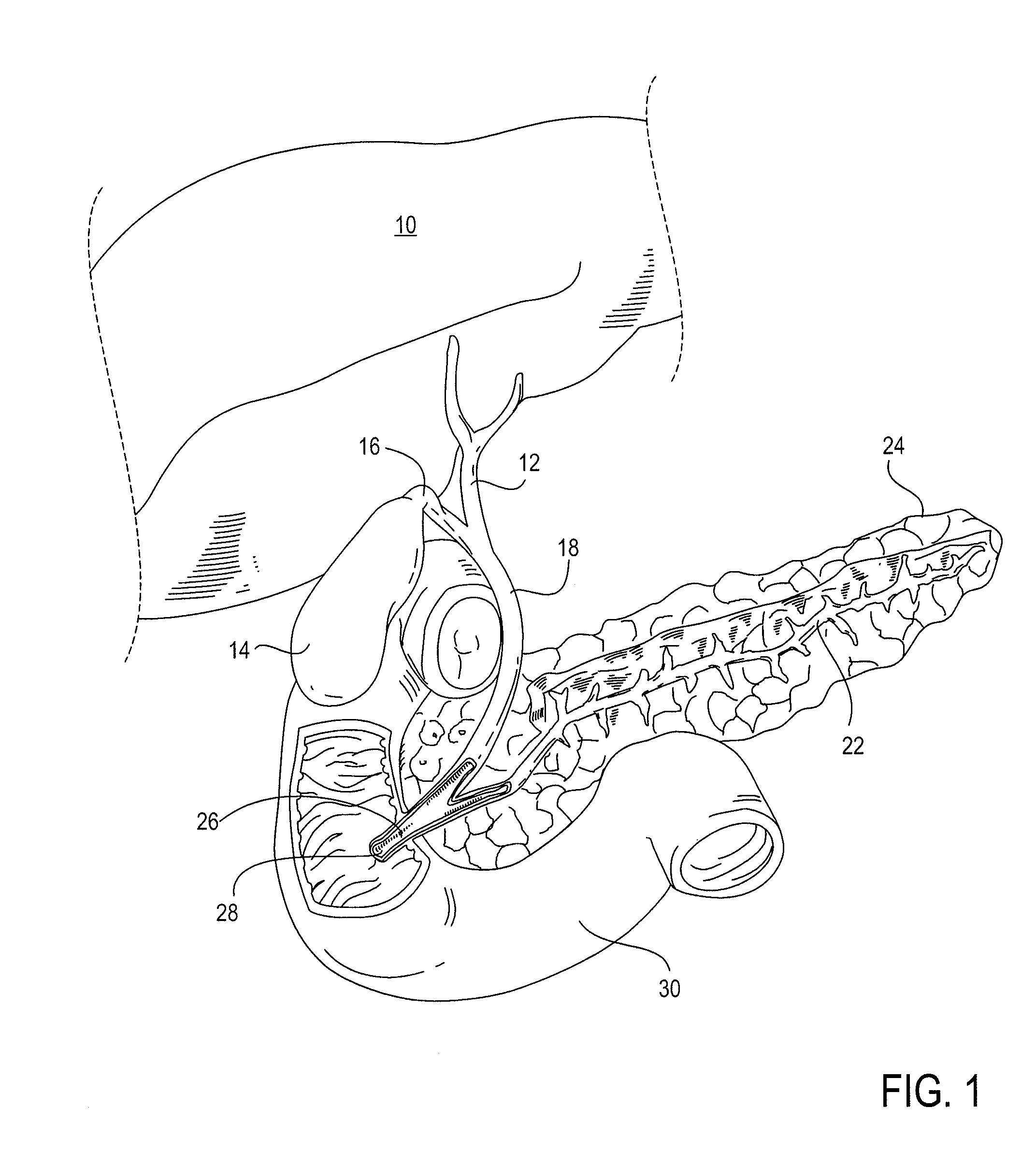 Biliary shunts, delivery systems, and methods of using the same