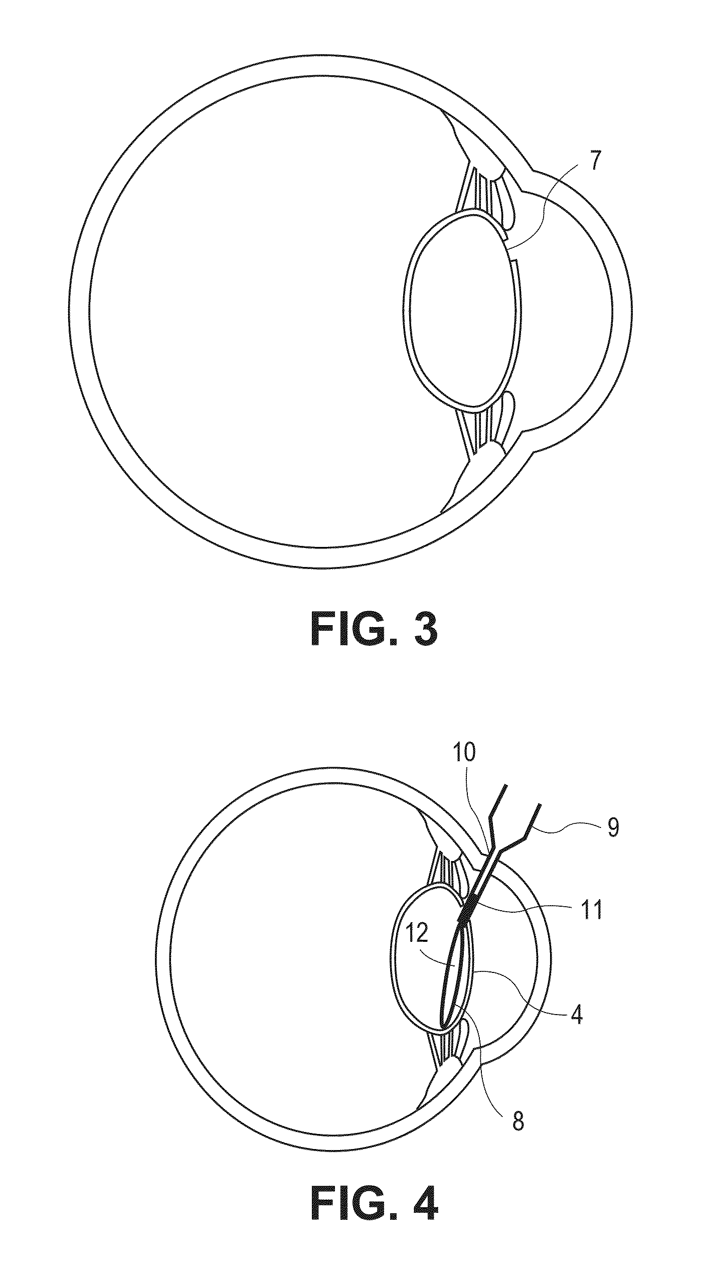 Accommodating intraocular lens