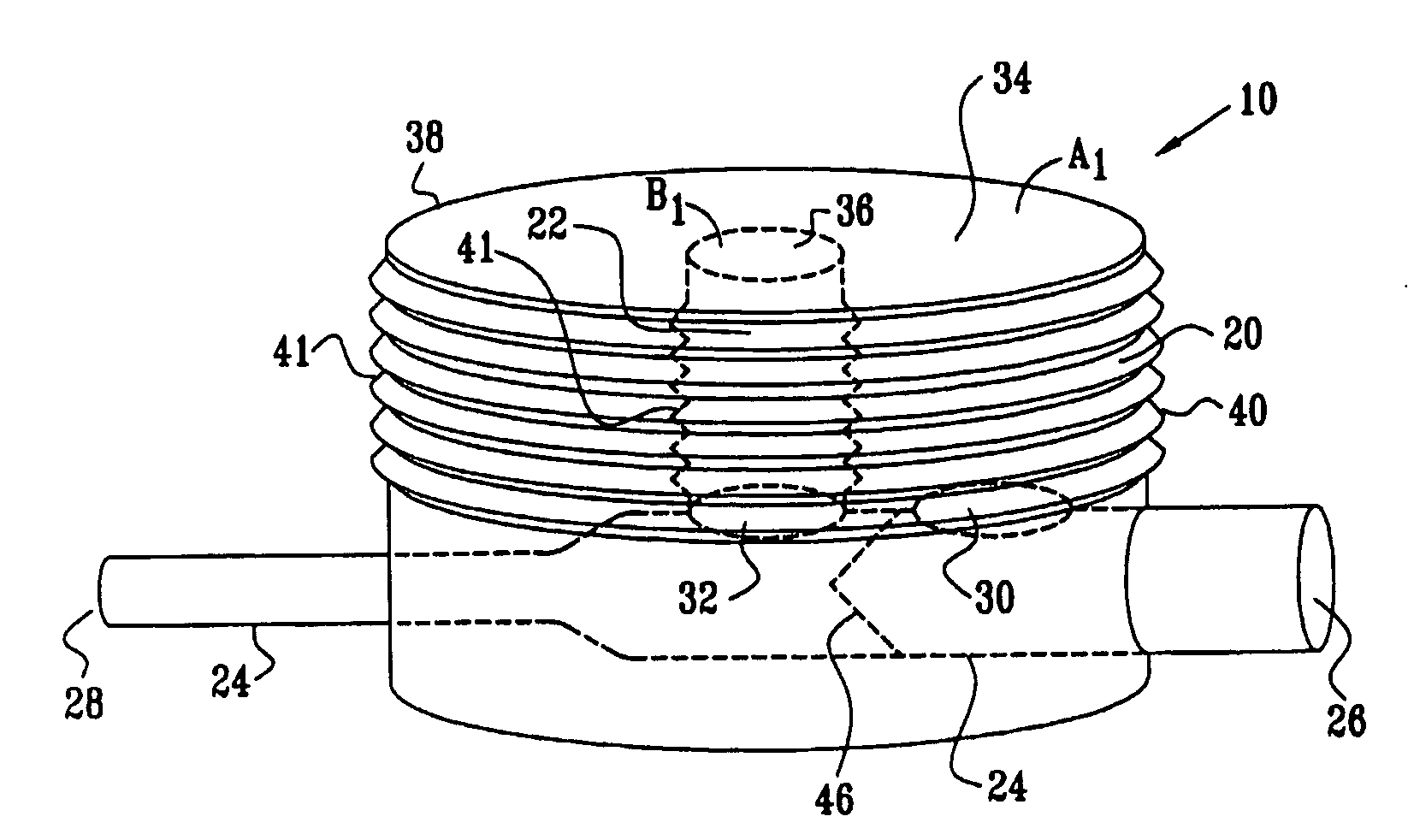 Extracardiac Blood Flow Amplification Device