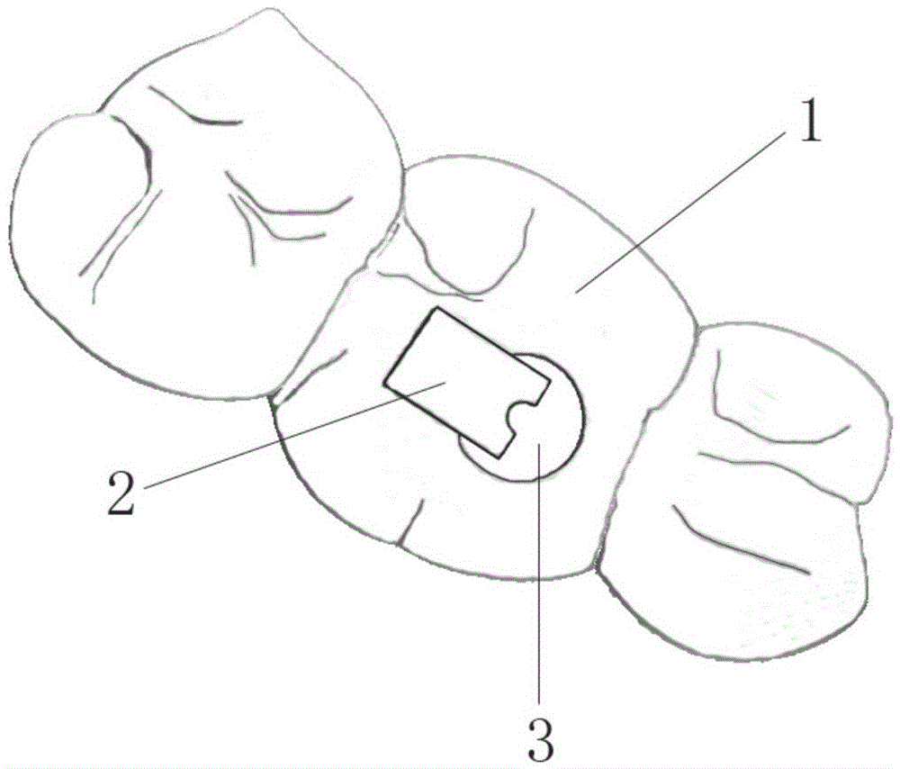 Navigation device for root canal treatment and making method thereof