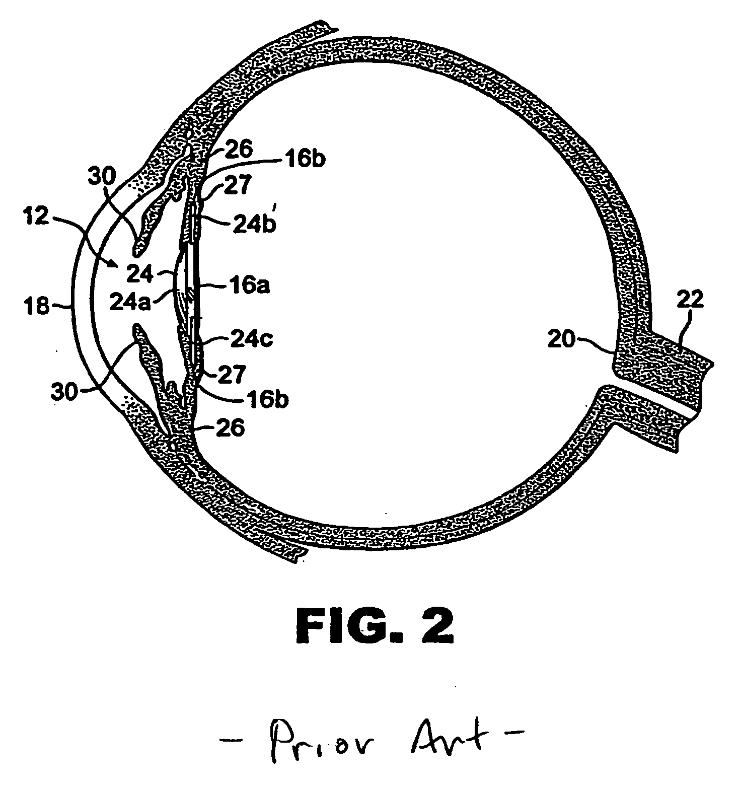 Accommodative intraocular lens