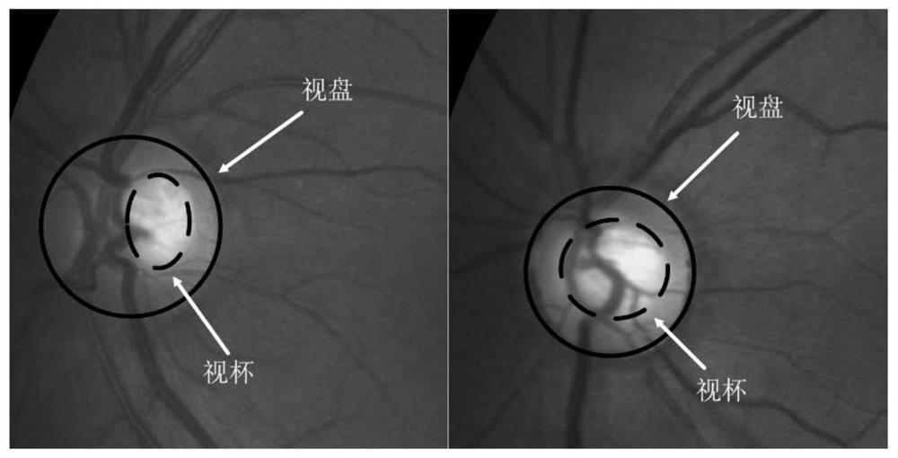 Optic cup and optic disk segmentation method based on fundus image data set transfer learning