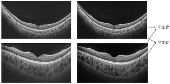 Choroidal OCT image enhancement method and device based on signal reverse compensation