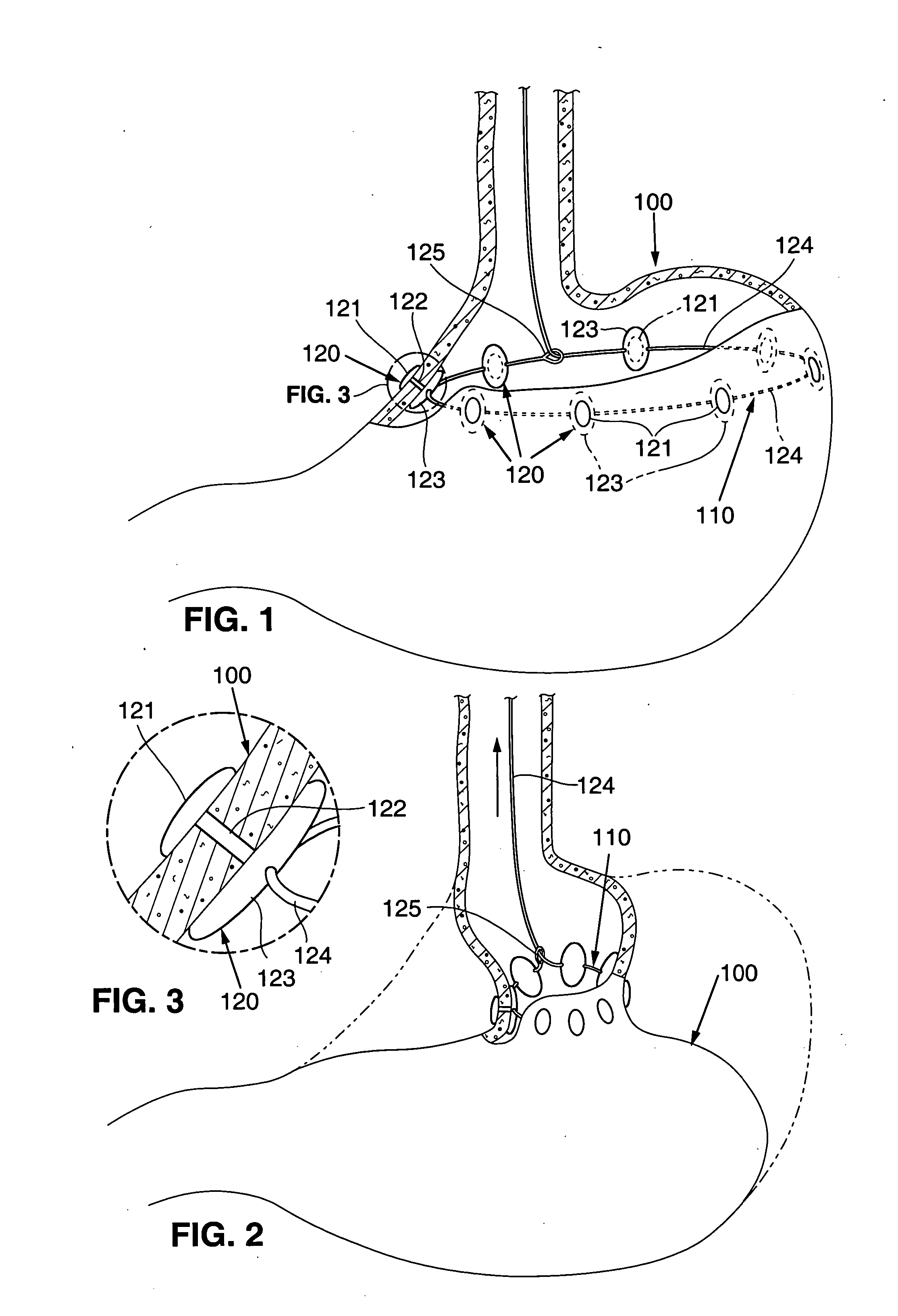 Endoscopic gastric constriction device