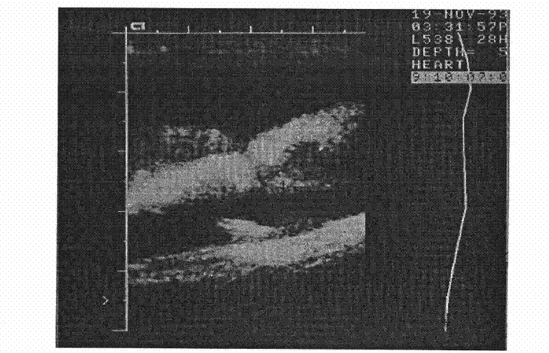 Method for preparing silkworm powder, pupa powder or pupa serum powder containing antibacterial peptide