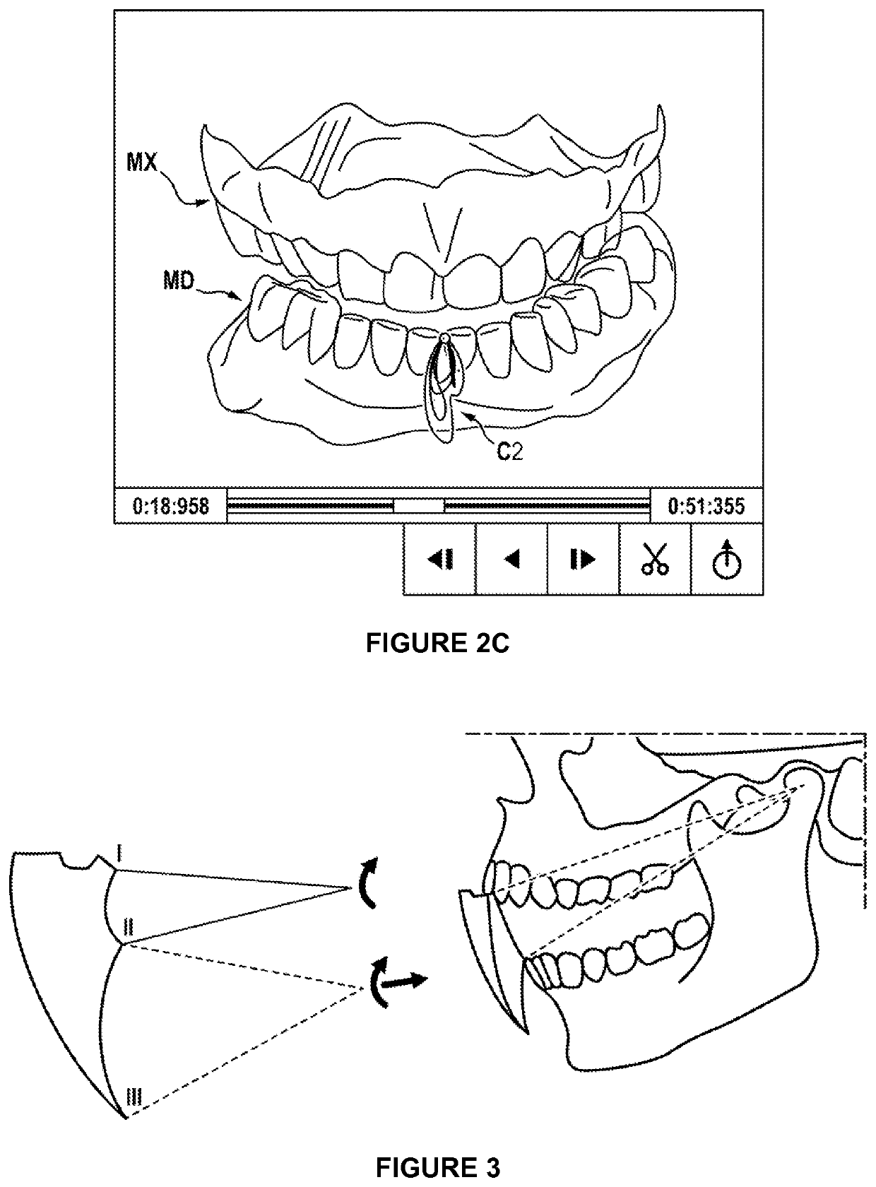 Method for animating models of the mandibular and maxillary arches of a patient in a corrected intermaxillary relationship