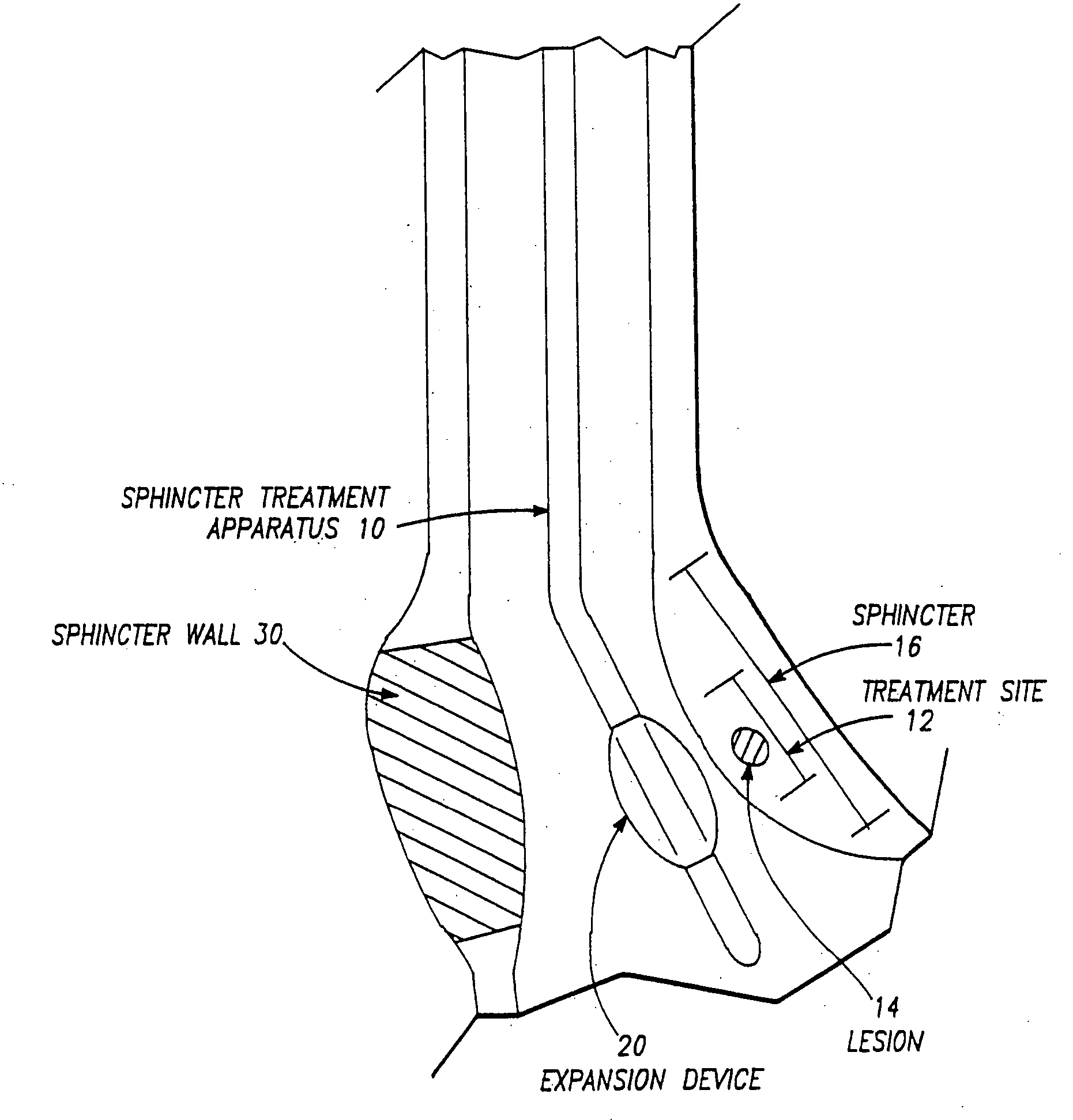 Apparatus to treat esophageal sphincters