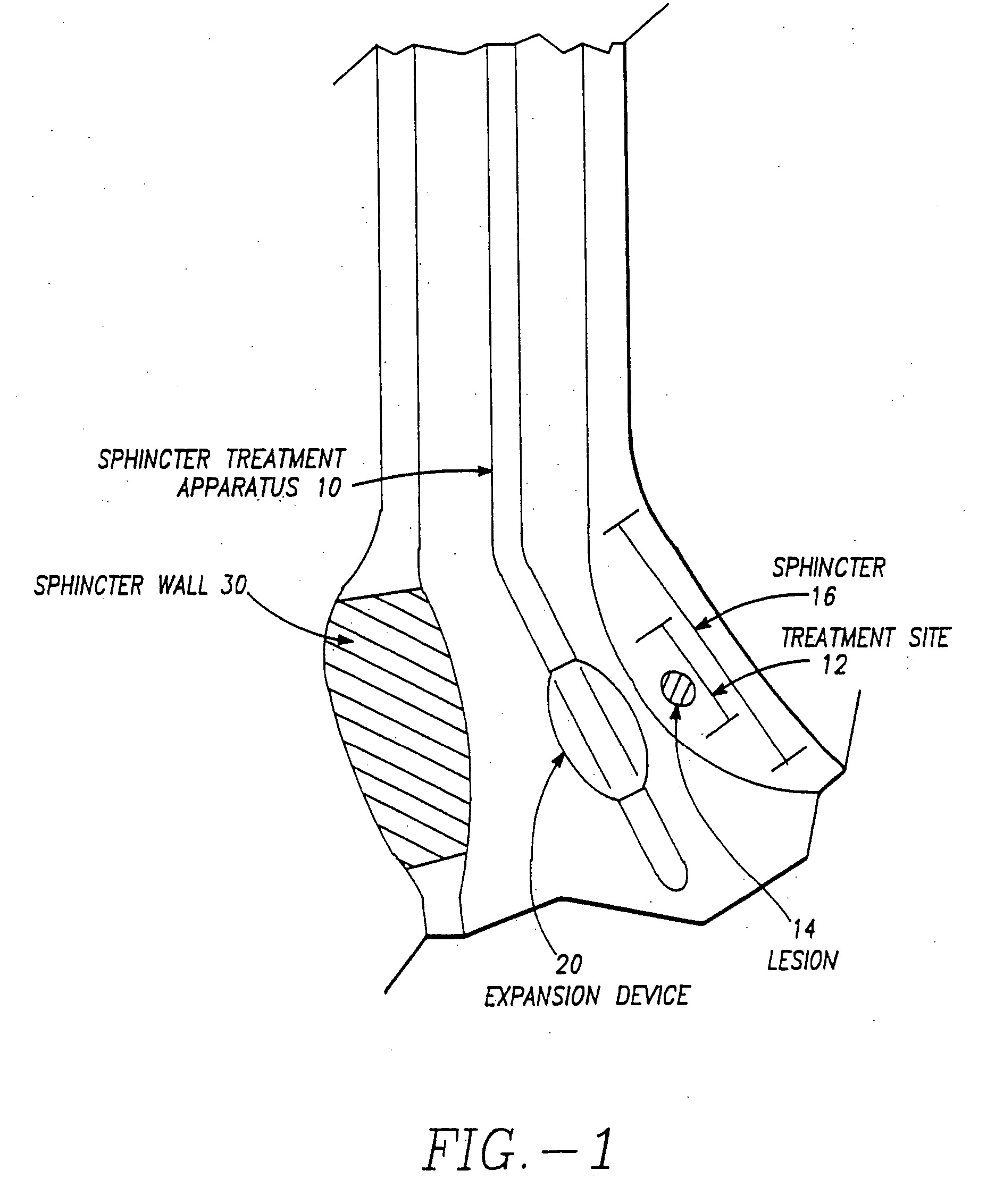 Apparatus to treat esophageal sphincters